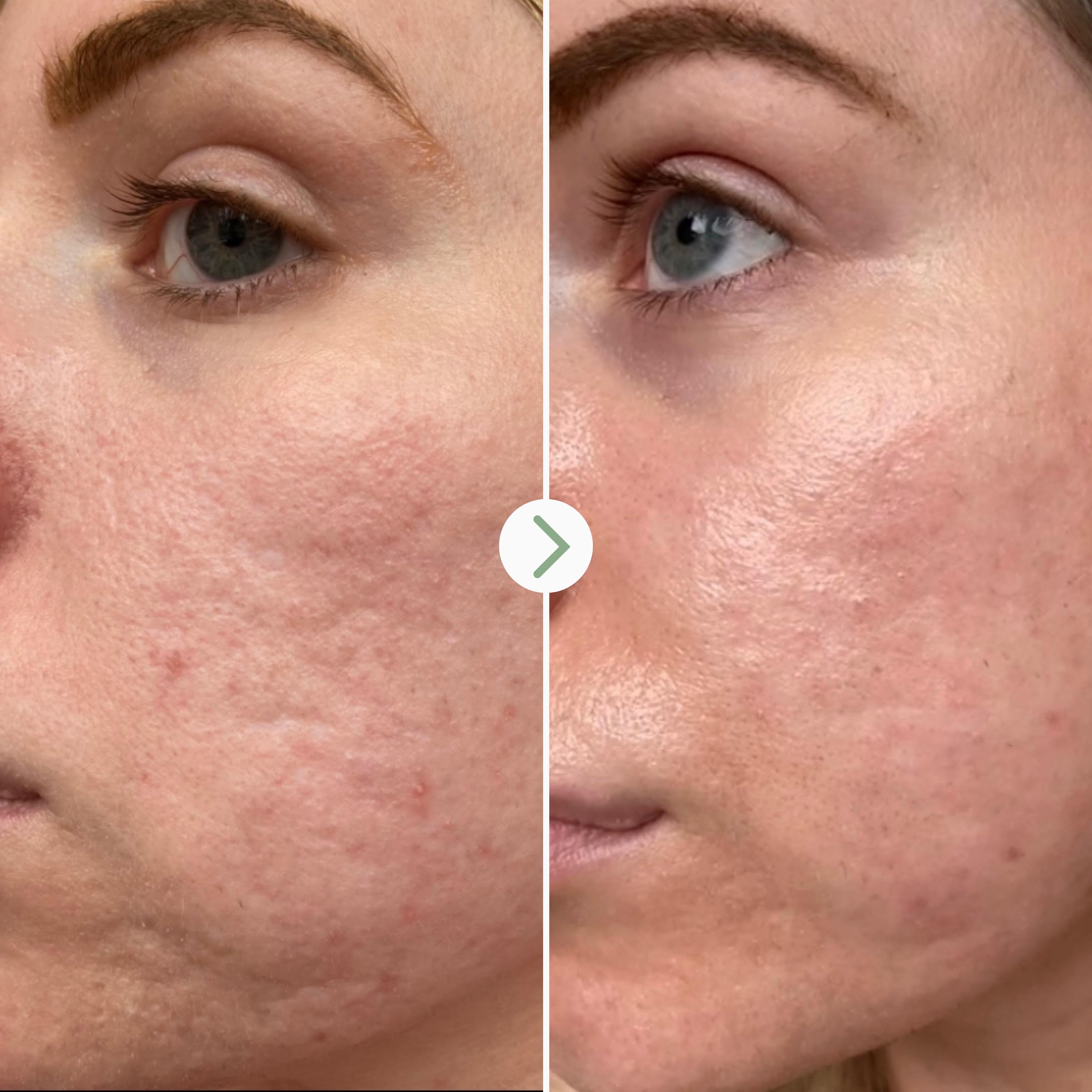 Pai Skincare Hyaluronic Acid Serum for Face - Hydrating & Plumping Anti-Aging Moisturizer - Vegan & Cruelty-Free Skincare - Perfect for Dry Skin & Wrinkle Reduction