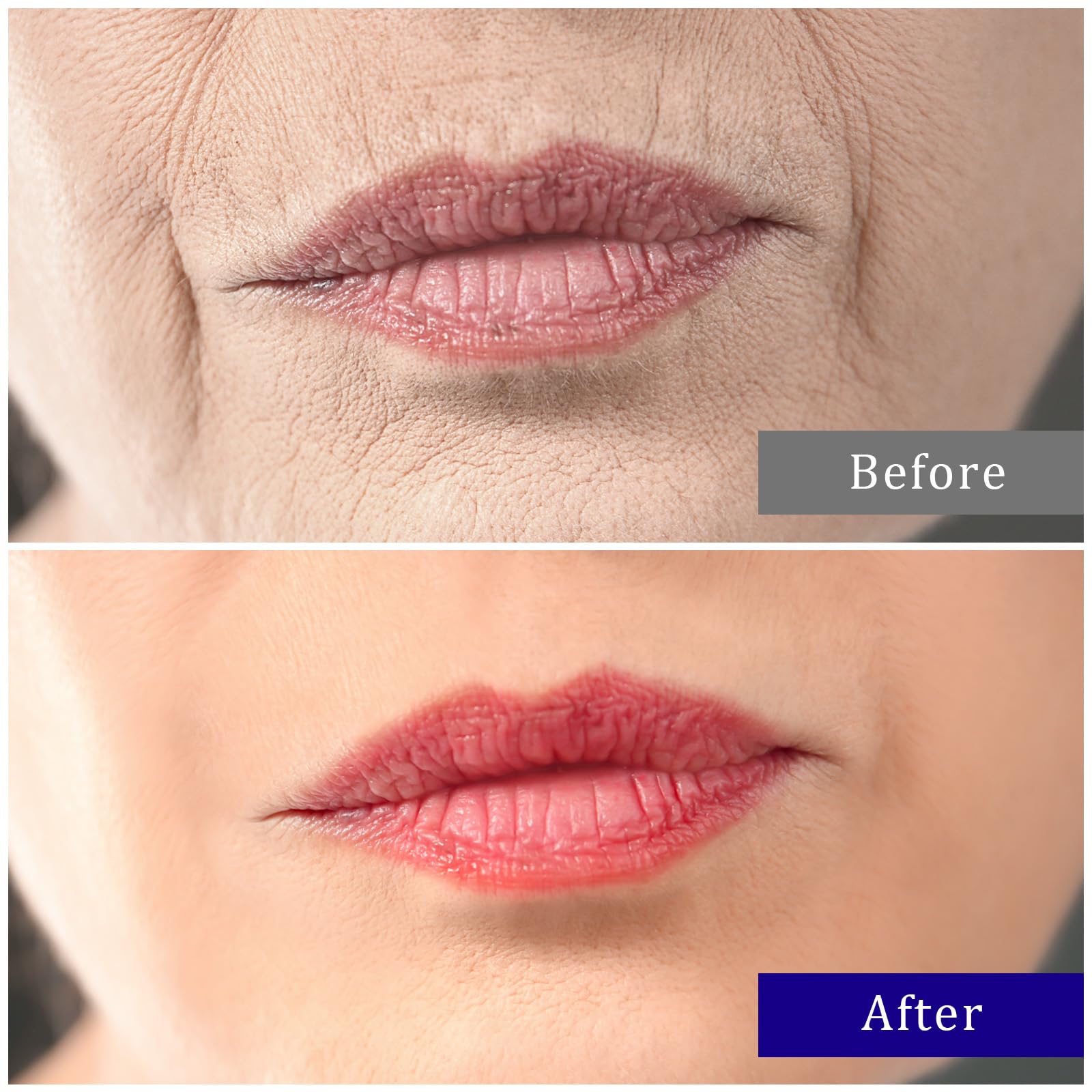 Best Upper Lip Wrinkle Treatment - Anti Wrinkle Patches for Overnight Use | Smooth Smile Lines & Reduce Lip Wrinkles | Perfect for Nighttime Skincare Routine & Anti-Aging Care