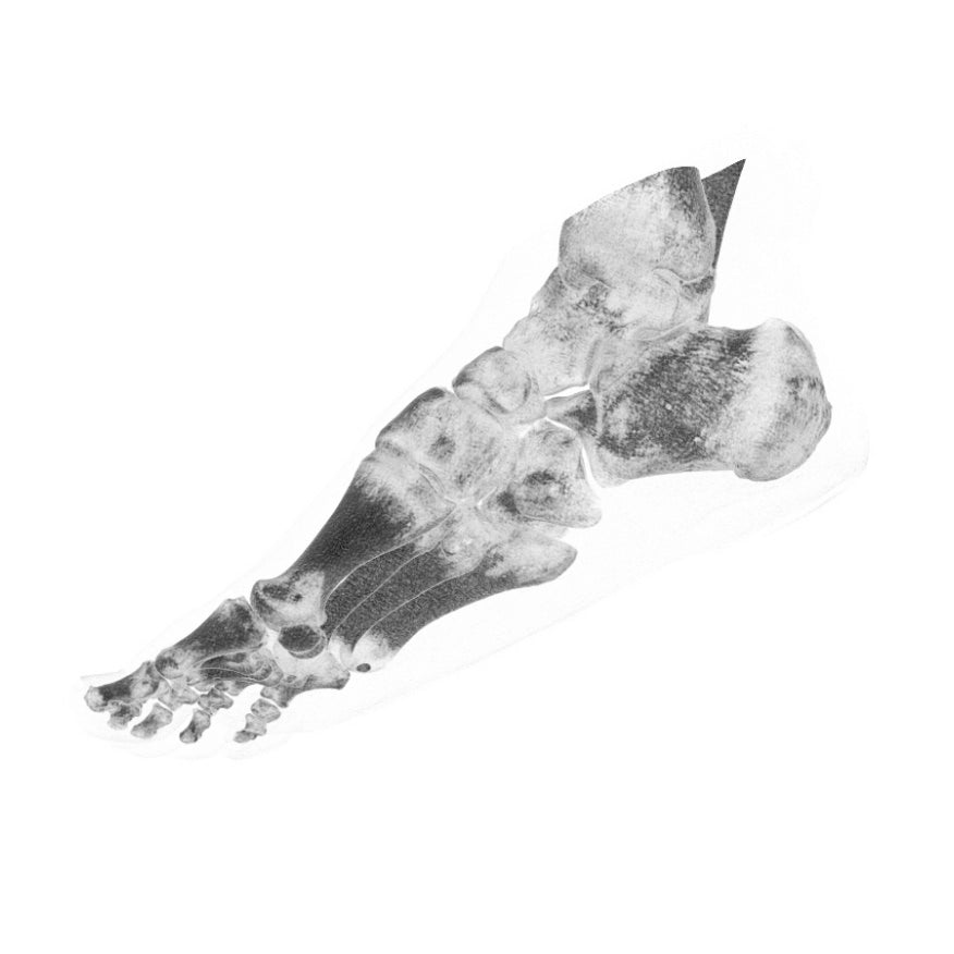 Foot Phantom Metatarsal Fractures Model - Realistic CT Scan & X-Ray Training Tool for Medical Students & Radiologists - Perfect for Anatomy Study & Diagnostic Practice