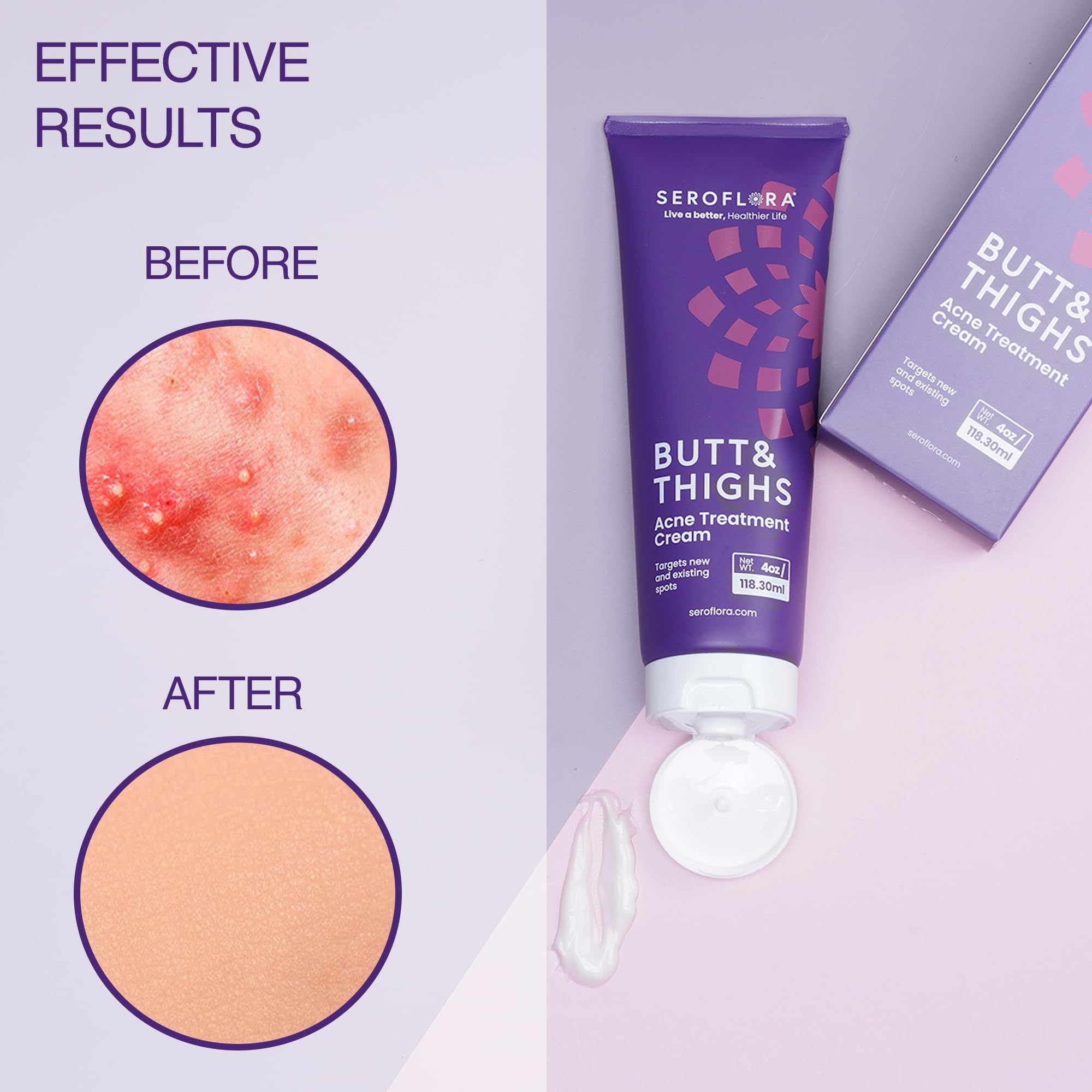 Acne & Razor Bump Treatment Cream - Pimple, Zit & Ingrown Hair Serum for Bikini Area | Post-Shave & Waxing Soothing Solution | Perfect for Sensitive Skin Care & Body Grooming