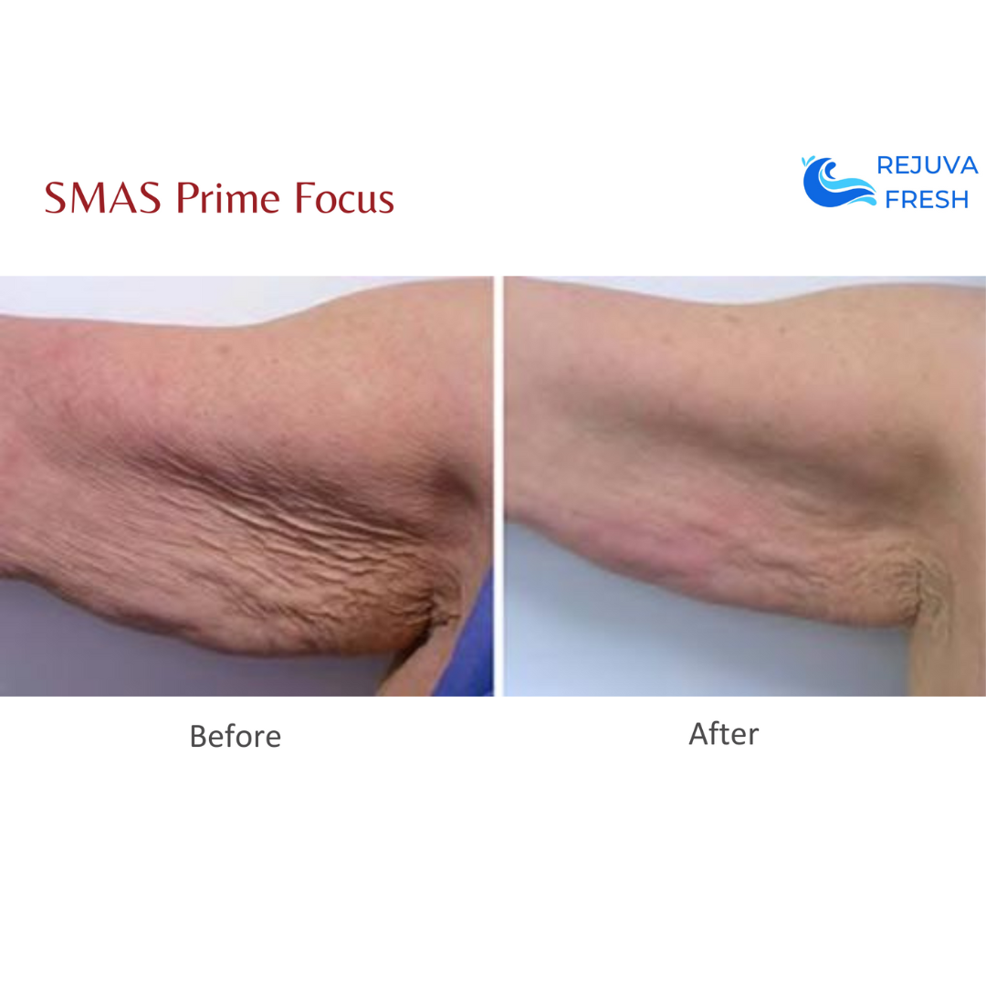 SMAS Prime Focus Professional HIFU Machine for Body & Face Lifting - Anti-Aging Skin Tightening & Wrinkle Reduction Device - At-Home Beauty Salon & Spa Treatment Equipment