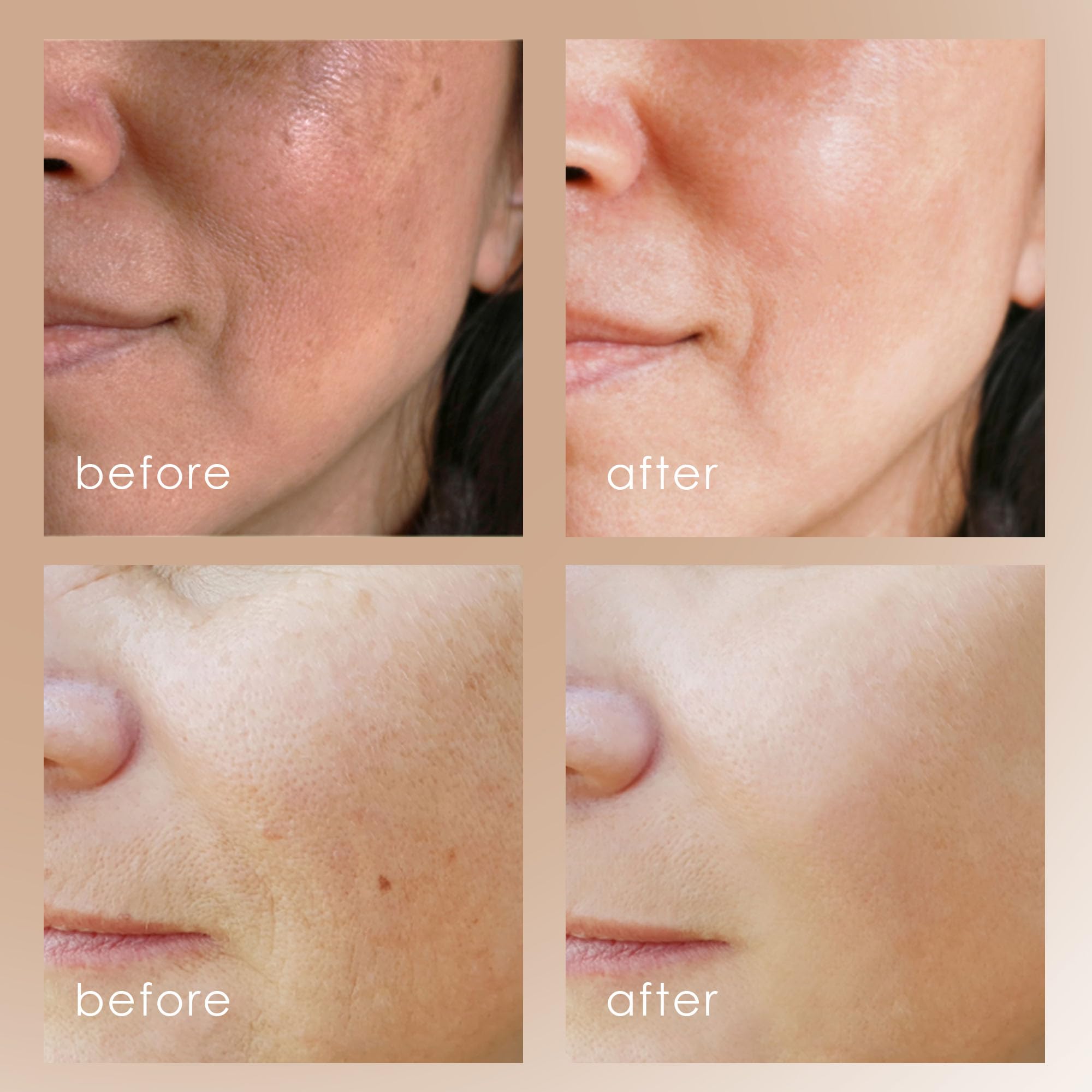 Project E Beauty Facial Microdermabrasion Wand - Gentle Exfoliating Device for Wrinkles, Fine Lines & Pores Reduction - 4 Interchangeable Heads with Vacuum Suction - Achieve Fresh, Radiant Skin - Perfect for At-Home Spa Treatments & Anti-Aging Skincare Routine