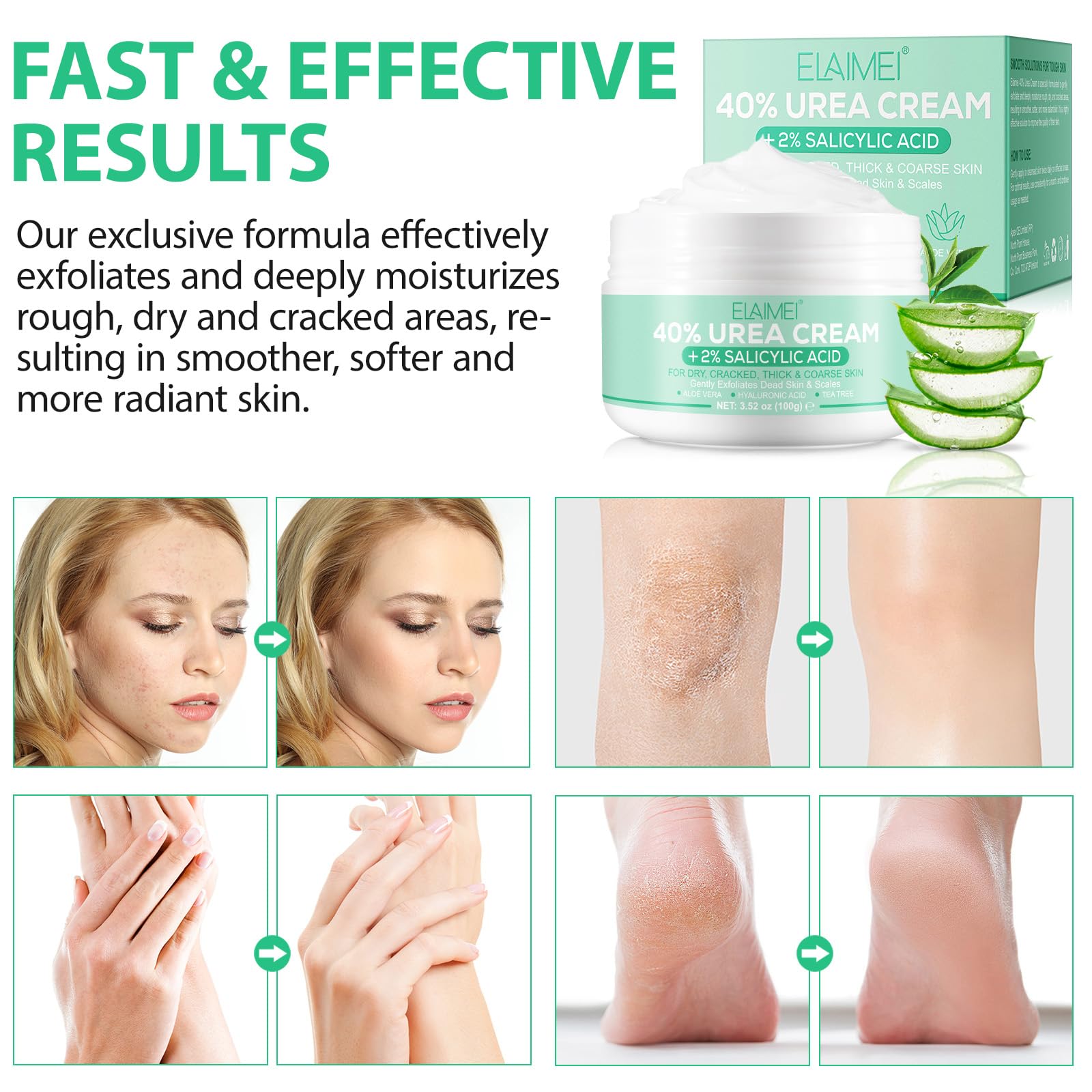 40% Urea Foot Cream for Cracked Heels & Dry Skin (3.52 oz) - Intensive Moisturizing Treatment with 2% Salicylic Acid, Tea Tree Oil & Aloe Vera - Best for Rough Feet, Elbows, Hands & Knees - Perfect for Pedicures, Winter Care & Daily Foot Repair