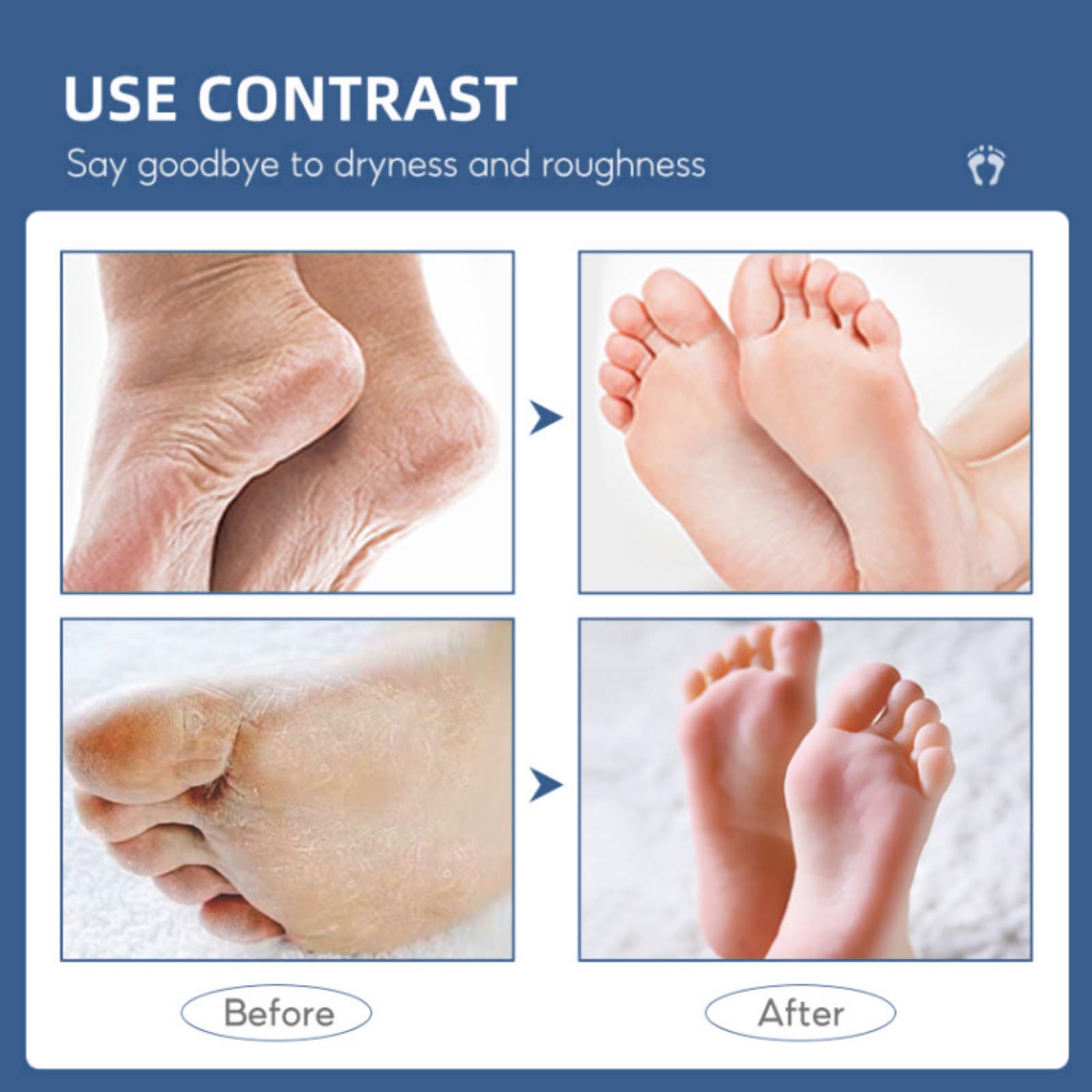 60% Urea Foot Cream for Cracked Heels & Dry Skin - 200ml Moisturizing Hand & Foot Repair Treatment - Intense Hydration for Rough, Calloused Feet - Perfect for Daily Foot Care & Pedicure Prep