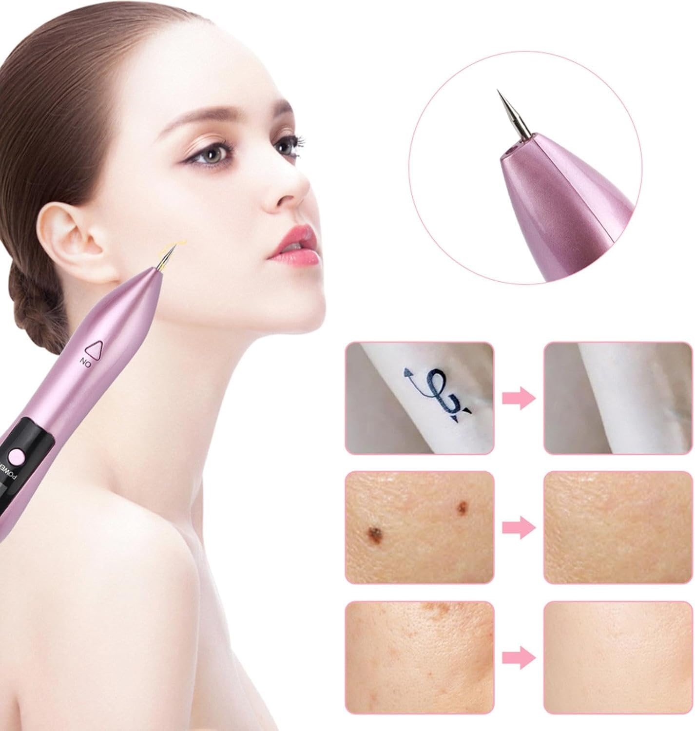 Professional Mole & Spot Remover Pen - Fast & Painless Skin Tag Removal for Face & Body - Perfect for Home Use & Travel Skincare