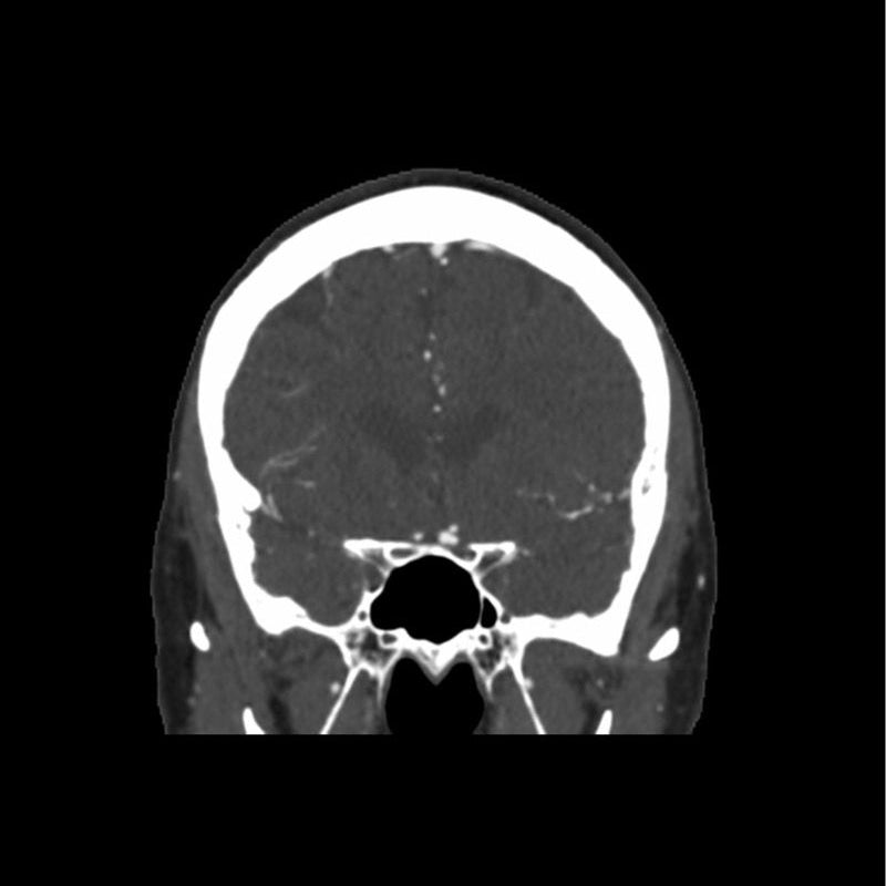 CTA Aneurysm Head Phantom for CT Scan and X-Ray Training - High-Quality Medical Simulation Tool for Radiology Education and Diagnostic Practice