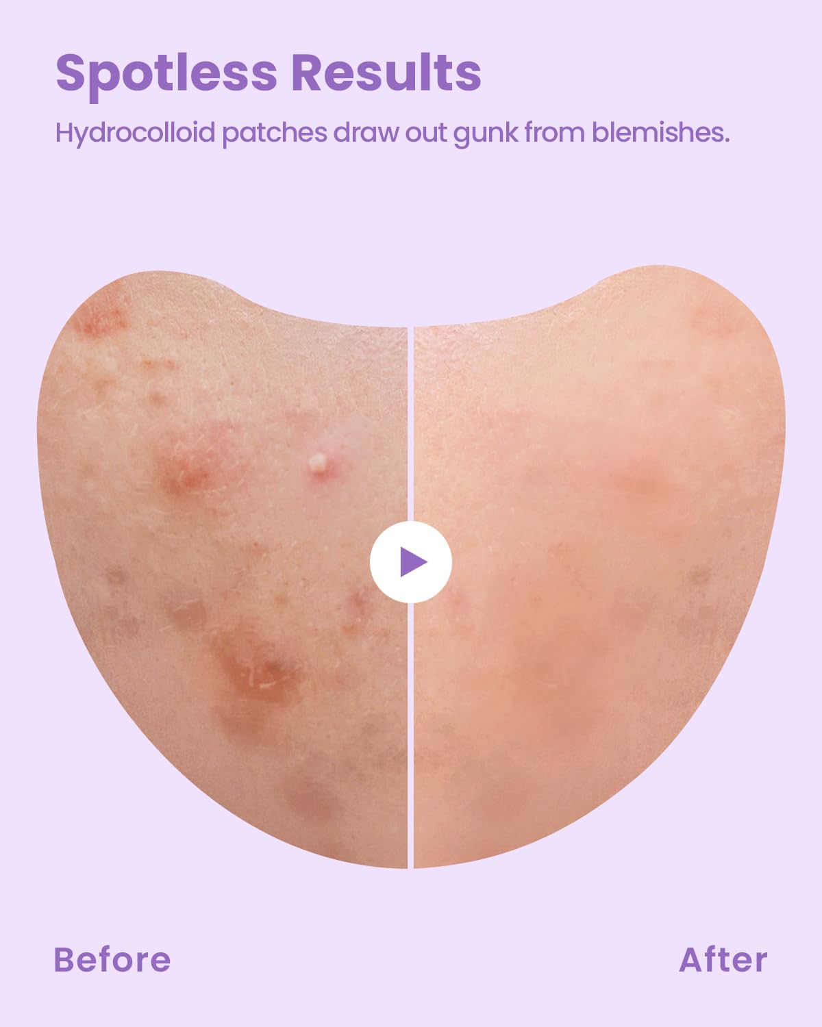 GLAM UP Spotless Patch - Hydrocolloid Acne Patches for Face, Cheek & Body, Blackhead Treatment, Vegan & Cruelty-Free (12 Count) - Perfect for Overnight Acne Care & Skin Healing
