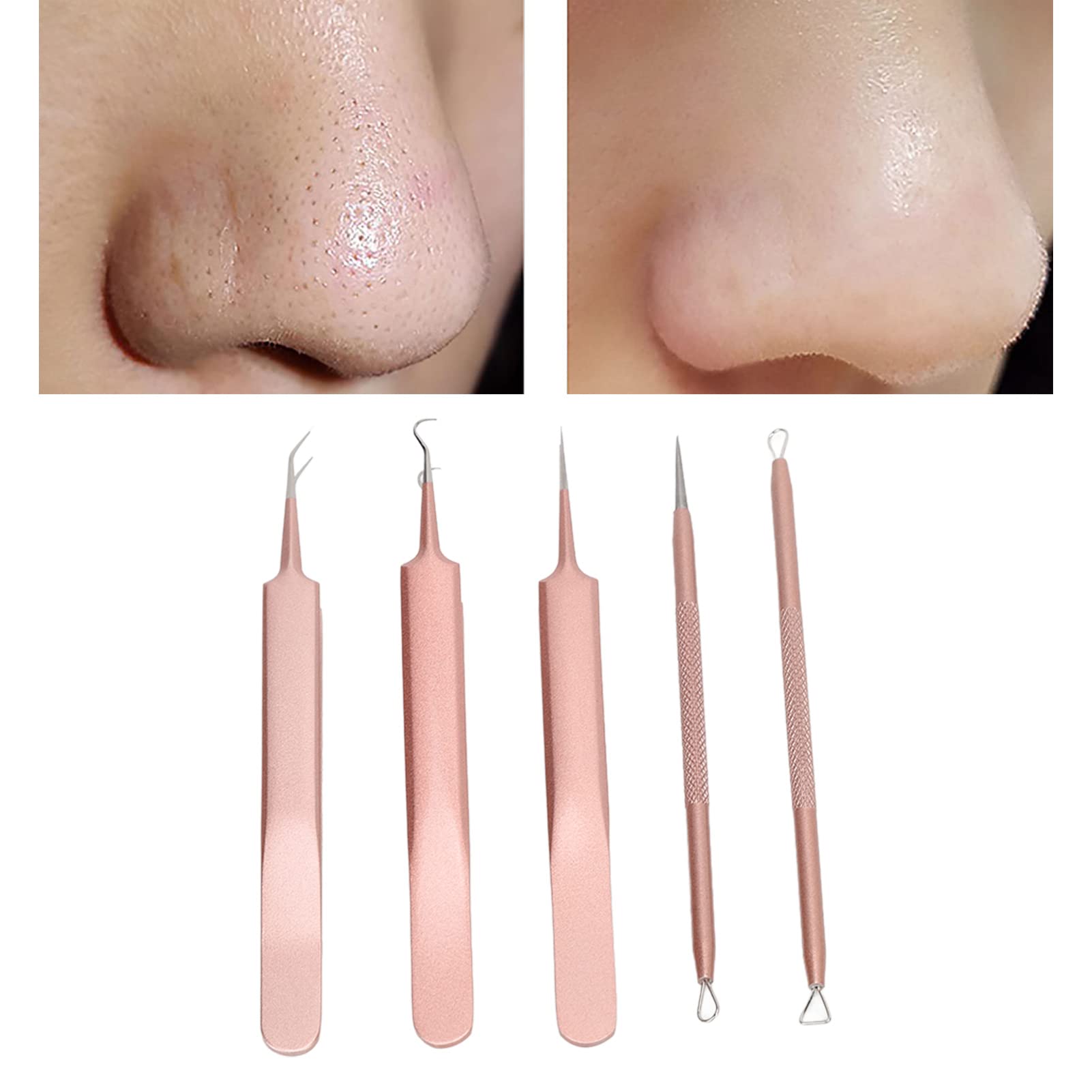 EXCLUZO Professional Pimple Extractor Needles Kit - Stainless Steel Blackhead & Whitehead Remover, Non-Slip Pore Cleaner Tools for Acne Treatment (Rose Gold) - Perfect for Home Skincare & Facial Care Routine