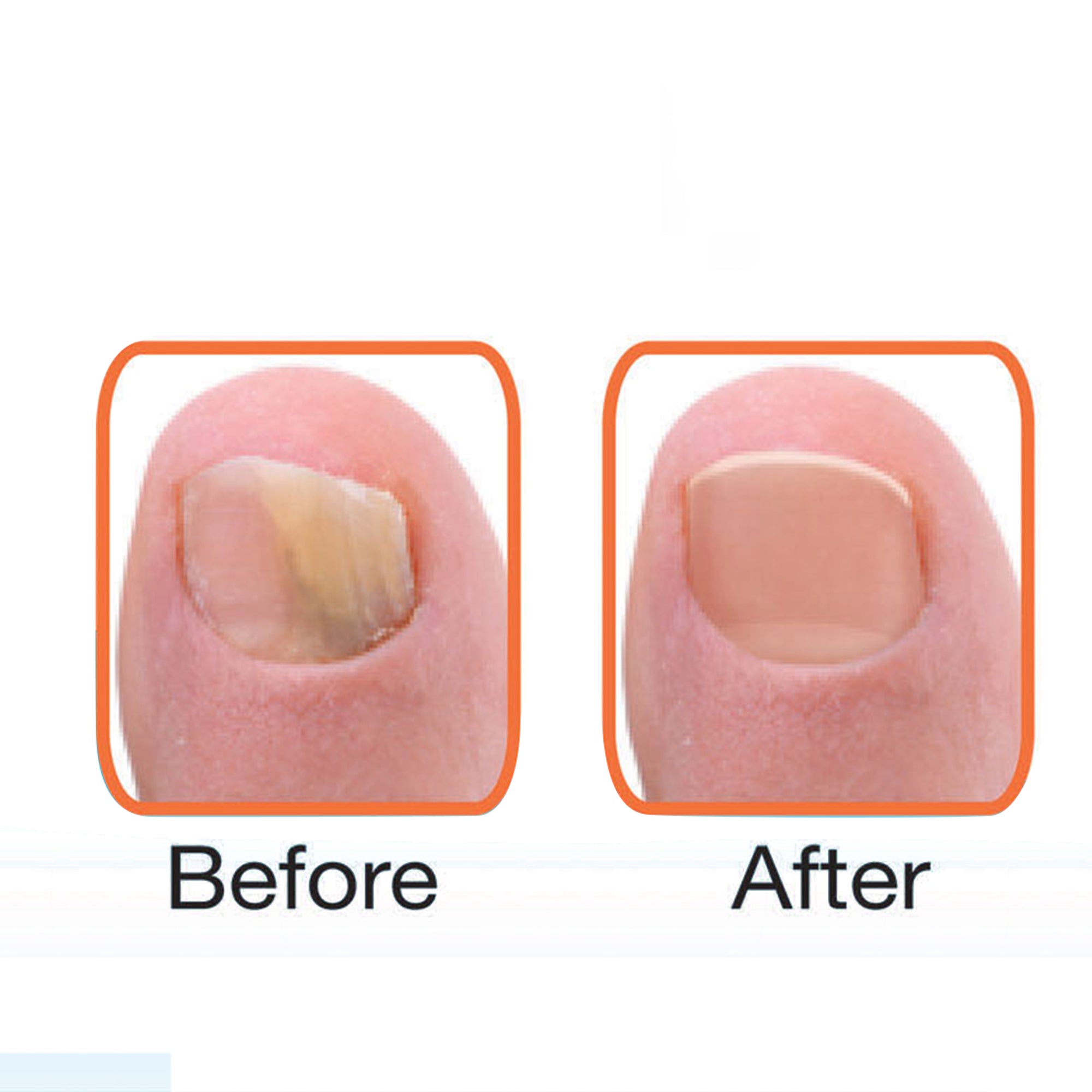 Aragan Secret Nail Fungus Treatment Oil - 10ml | Fast-Acting Toenail Fungus Repair Solution for Healthy Nails | Perfect for Athletes, Swimmers & Pedicure Lovers