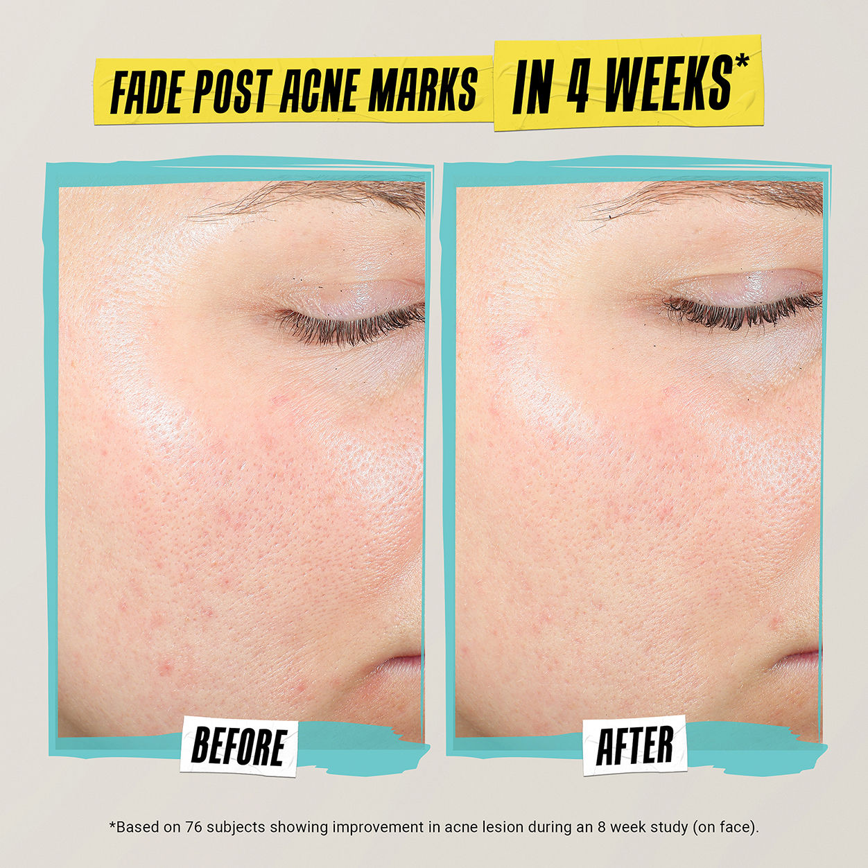 Best Acne Treatment Lotion for Clear Skin - Expert Formula to Prevent & Treat Breakouts | Perfect for Daily Skincare & Acne-Prone Skin