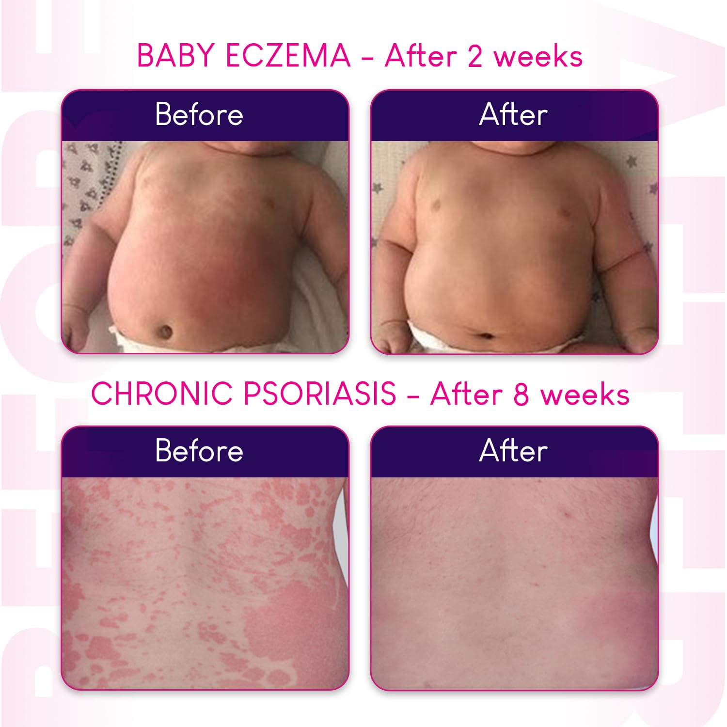 Hope's Relief Natural Intensive Dry Skin Cream - 6 Pack Bundle for Face, Hands & Body | Eczema, Psoriasis & Dermatitis Treatment | Moisturizer for Dry, Itchy & Irritated Skin | 60g Each | Perfect for Daily Hydration & Sensitive Skin Care