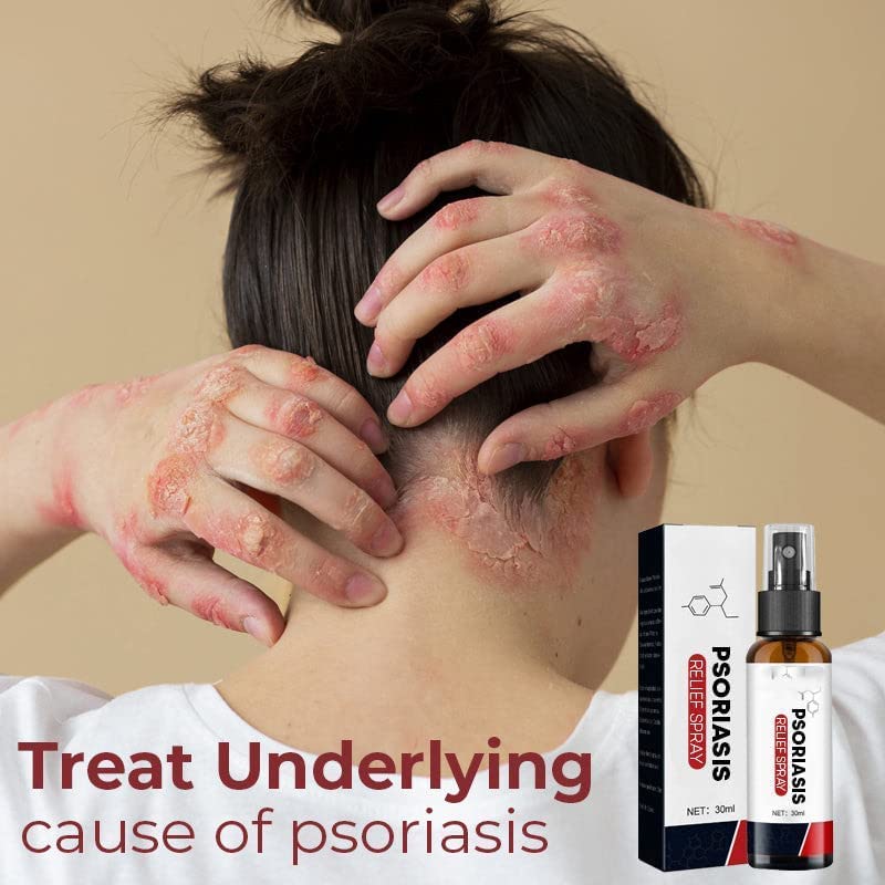 Dermax Psoriasis Treatment Spray for Scalp & Skin Relief – 30ml (2 Pack) – Fast-Acting Itch & Flake Solution for Dry, Irritated Skin – Perfect for Home, Travel & Daily Care