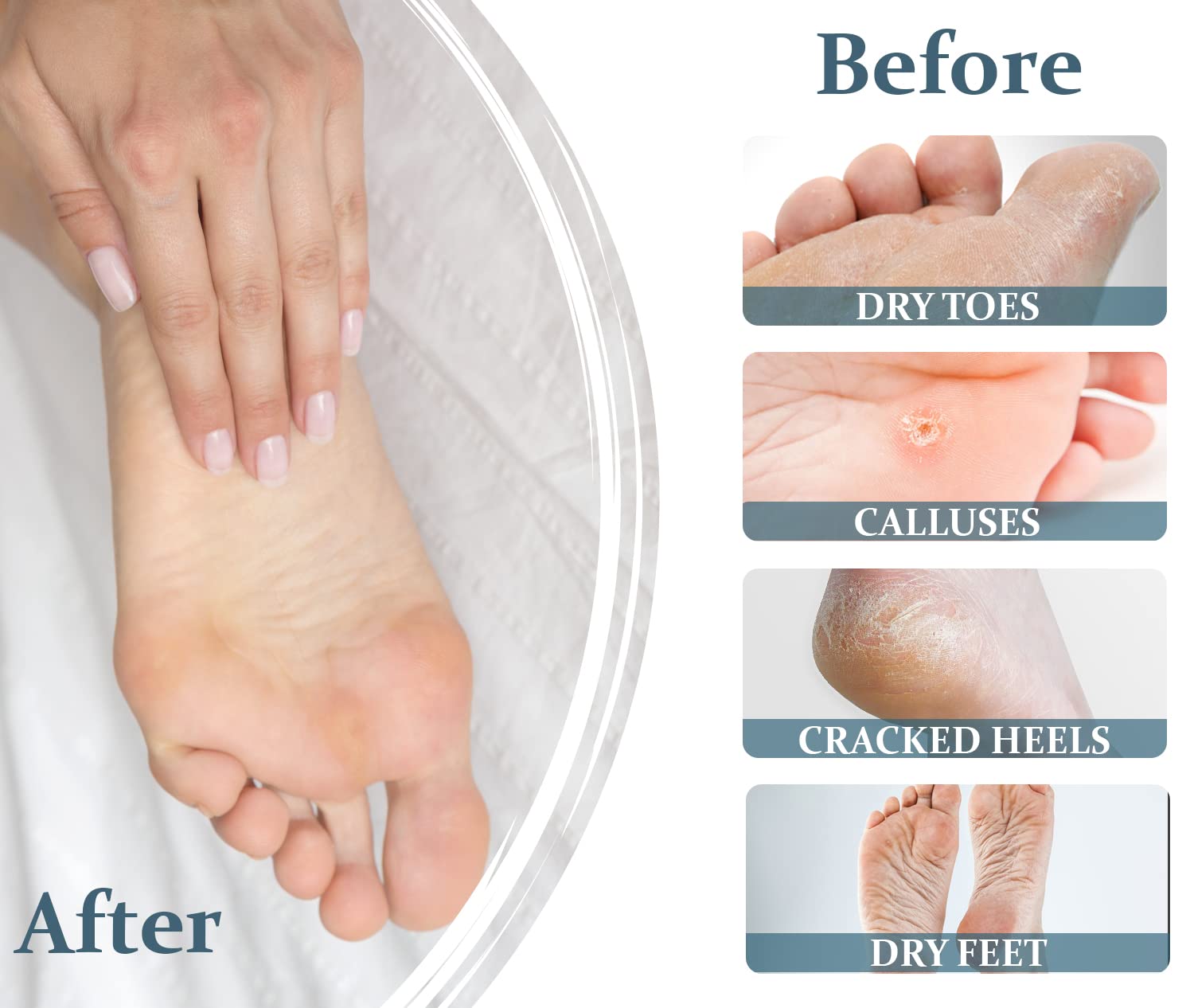 Urea Foot Cream for Dry & Cracked Heels - Intensive Moisturizing Treatment with Goat Milk Proteins - Travel Size Foot Lotion for Soft, Smooth Feet | Perfect for Daily Foot Care, Cracked Heel Repair & On-the-Go Hydration