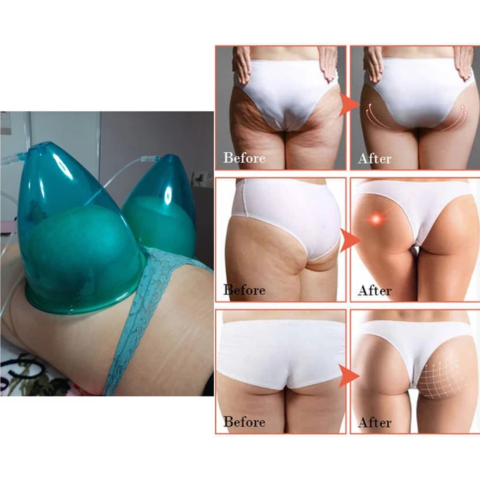 XJZHANG Electric Vacuum Butt Lifting Machine - Manual Massage Cups for Body Contouring & Breast Enhancement - Vacuum Therapy for Cellulite Reduction & Skin Tightening (Blue) - Perfect for Home Spa, Postpartum Recovery & Body Shaping Treatments