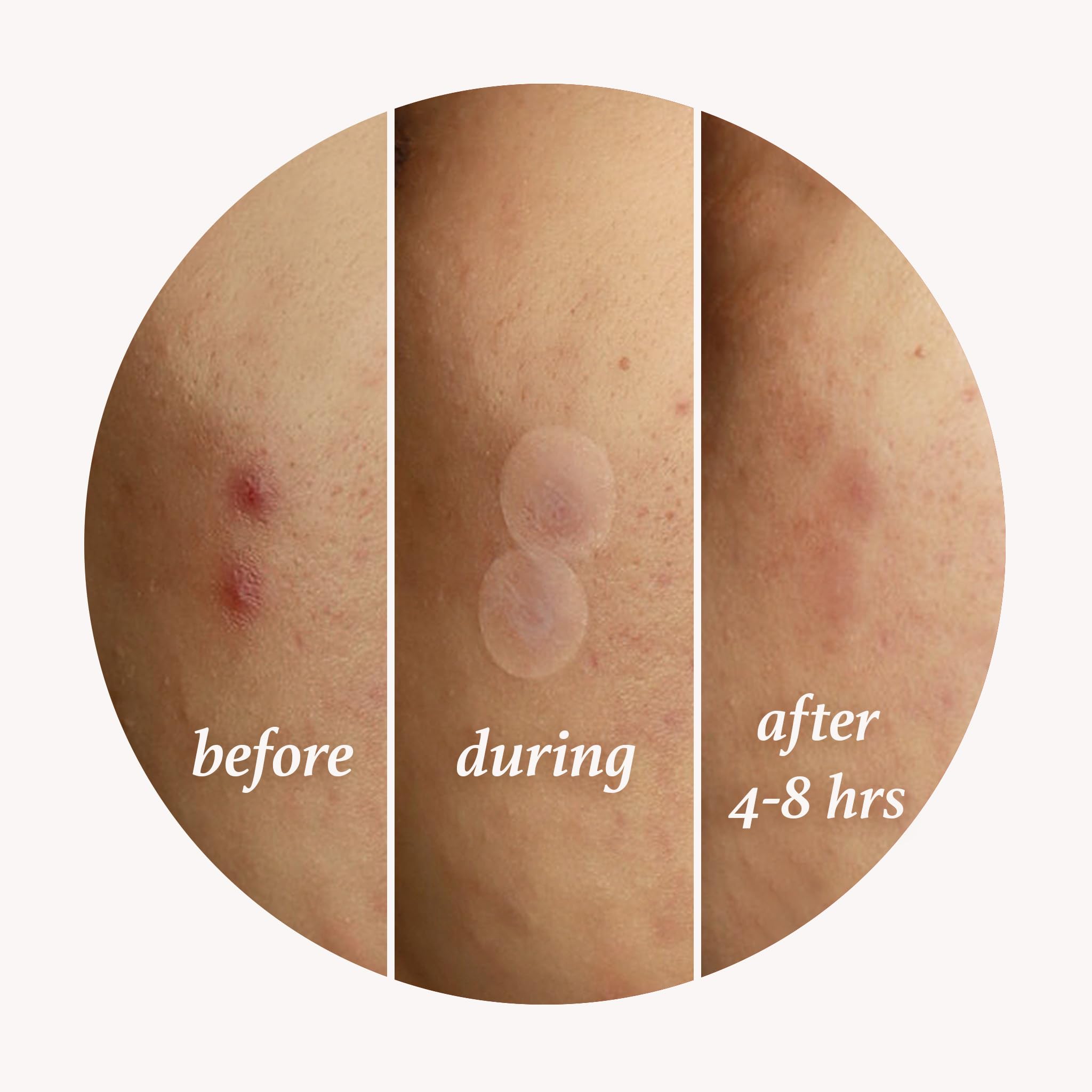 Julep Patch Me Up Waterproof Pimple Patches – 72 Hydrocolloid Acne Patches with Tea Tree Oil for Clear Skin | Ultra-Thin Day & Potent Night Treatment | Reduces Blemishes & Scarring | 48 8mm & 24 12mm Patches | Perfect for Overnight Spot Treatment & Daily Acne Care