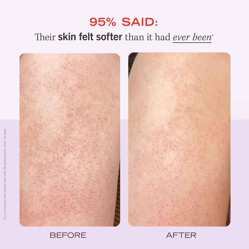 First Aid Beauty KP Bump Eraser Body Scrub with Fresh Strawberry - Exfoliating Treatment for Keratosis Pilaris & Smooth Skin - Perfect for Shower & Pre-Shave Routine