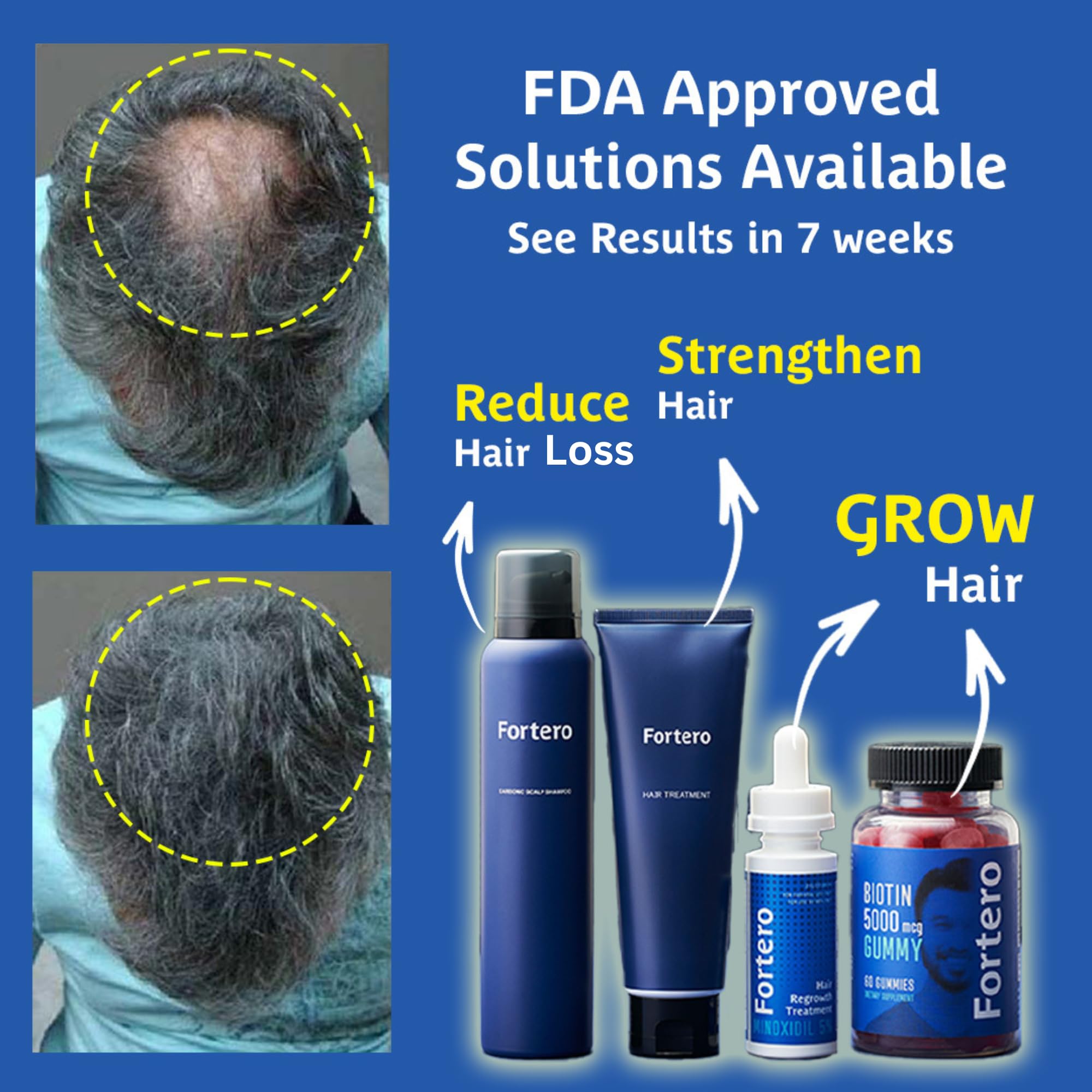 Fortero Hair Regrowth Treatment for Men - 5% Minoxidil Shampoo & Conditioner Set for Hair Loss, Baldness & Alopecia - Hair Thinning Solution & Restoration System Bundle - Perfect for Daily Use & Scalp Care Routine