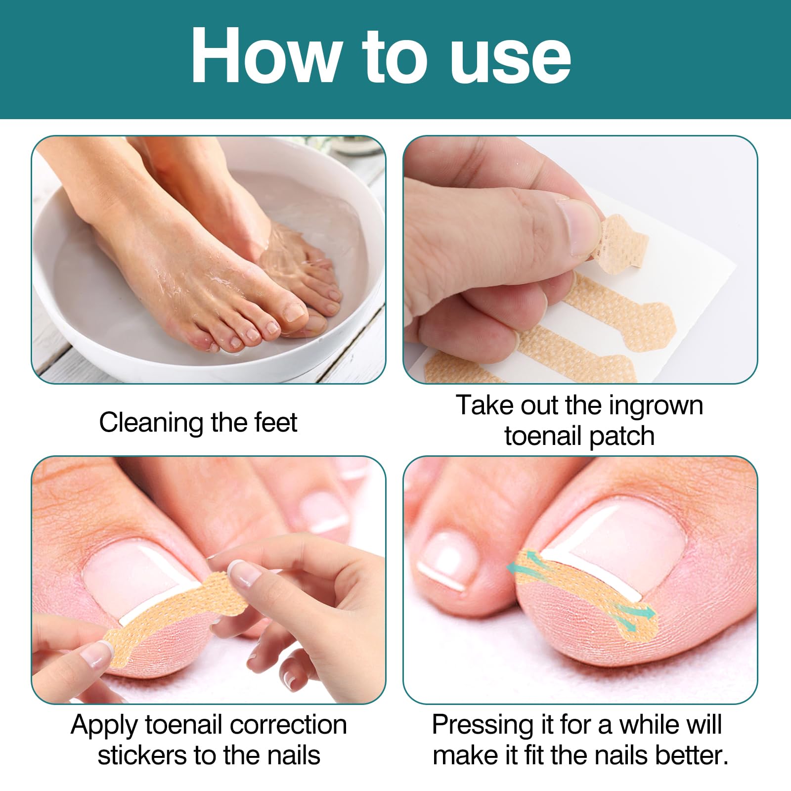**Professional Ingrown Toenail Treatment Strips – 100 Pcs Pedicure Kit for Pain Relief & Toenail Correction – Ideal for Home Care & Salon Use**
