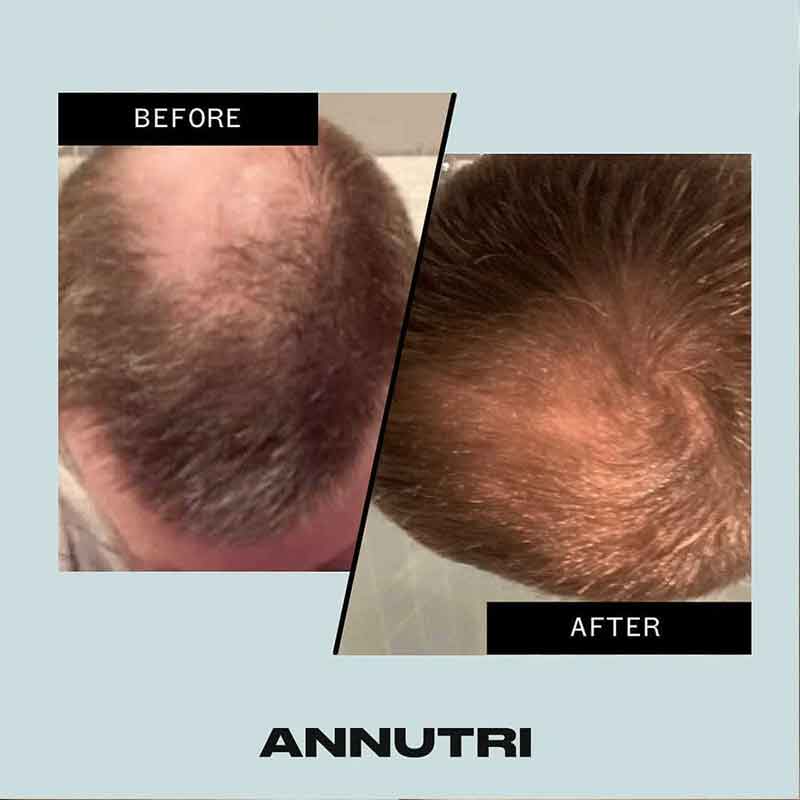 Annutri Grow It Hair Growth Supplement - 1 Month Supply for Thicker, Stronger Hair - Perfect for Men & Women with Thinning Hair or Hair Loss