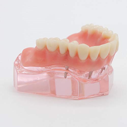 Dental Teeth Study Model - 1Pc Over Denture Inferior 4 Implant Demo Model for Dental Students & Professionals | Perfect for Classroom Demonstrations & Clinical Training