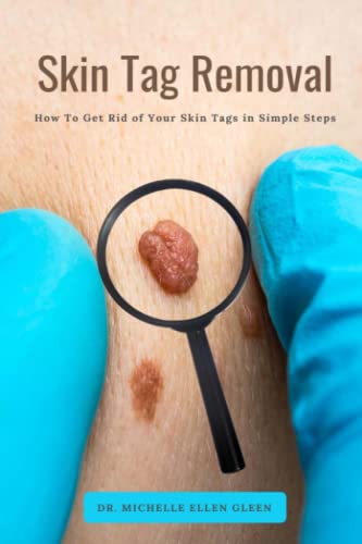 Skin Tag Remover - Safe & Effective Skin Tag Removal Kit for Easy At-Home Treatment | Fast & Painless Solution for Face, Neck & Body