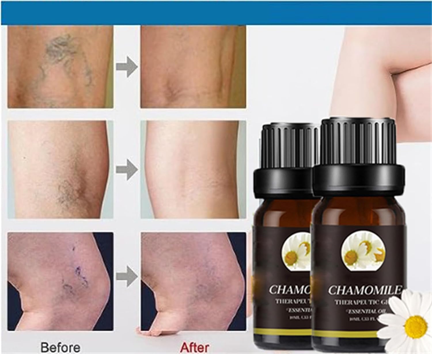 **Marrone Oil for Varicose Veins Relief – Natural Chamomile Essential Oil – Soothes Leg Pain & Improves Circulation – Perfect for Massage & Relaxation (1pc)**