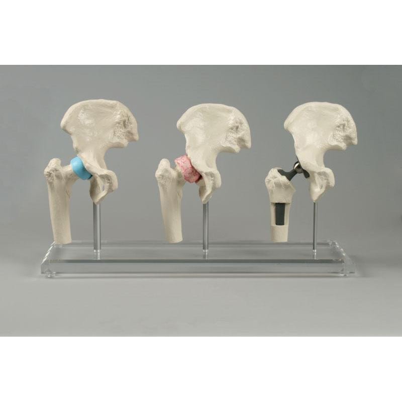 High-Quality Hip Implant Model - Medical Training & Surgical Demonstration Tool for Orthopedic Surgeons & Students