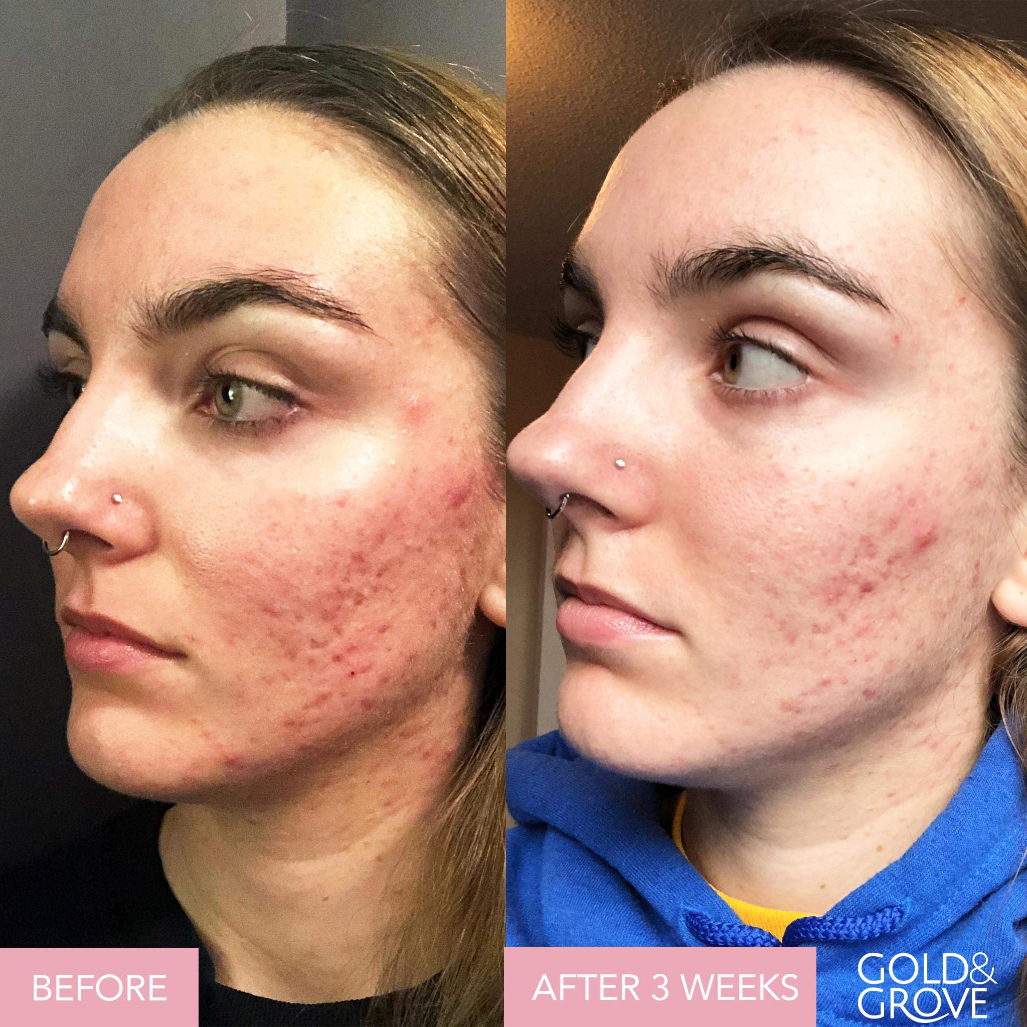 Blemish Blend Acne Vitamins for Clear Skin - Natural Acne Treatment & Skin Care Supplement for Teens & Adults - Supports Healthy Complexion at Home, Work & Gym