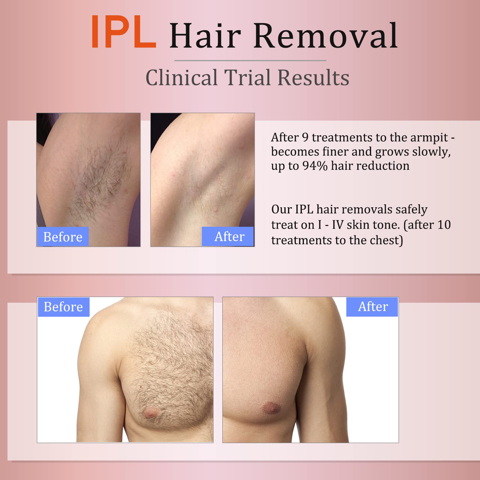 MiSMON IPL Hair Removal Device for Women & Men - Permanent At-Home Laser Hair Remover for Bikini Line, Legs, Underarms, Arms & Body - Safe with Skin Tone Sensor Technology - Perfect for Smooth Skin Before Beach, Wedding or Daily Use