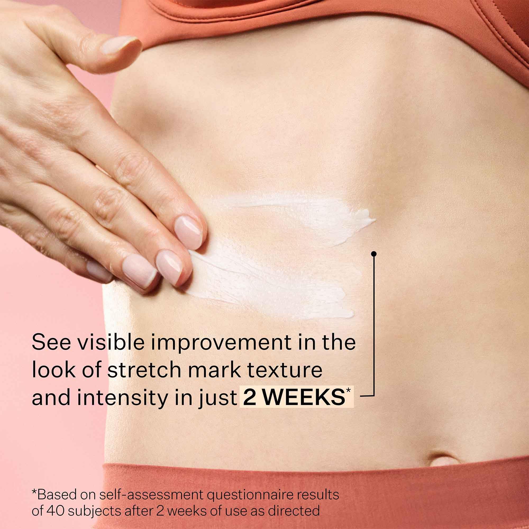 StriVectin SD Advanced™ Plus Intensive Moisturizer for Wrinkles & Stretch Marks - Anti-Aging Face & Body Cream with Collagen-Boosting Peptides & Hyaluronic Acid | Hydrating Skincare for Dry Skin, Fine Lines & Post-Pregnancy Care