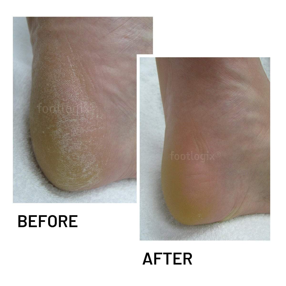 Footlogix Cracked Heel Repair Cream - 4.2oz Moisturizing Treatment for Dry, Cracked Feet - Perfect for Pedicures & At-Home Foot Care