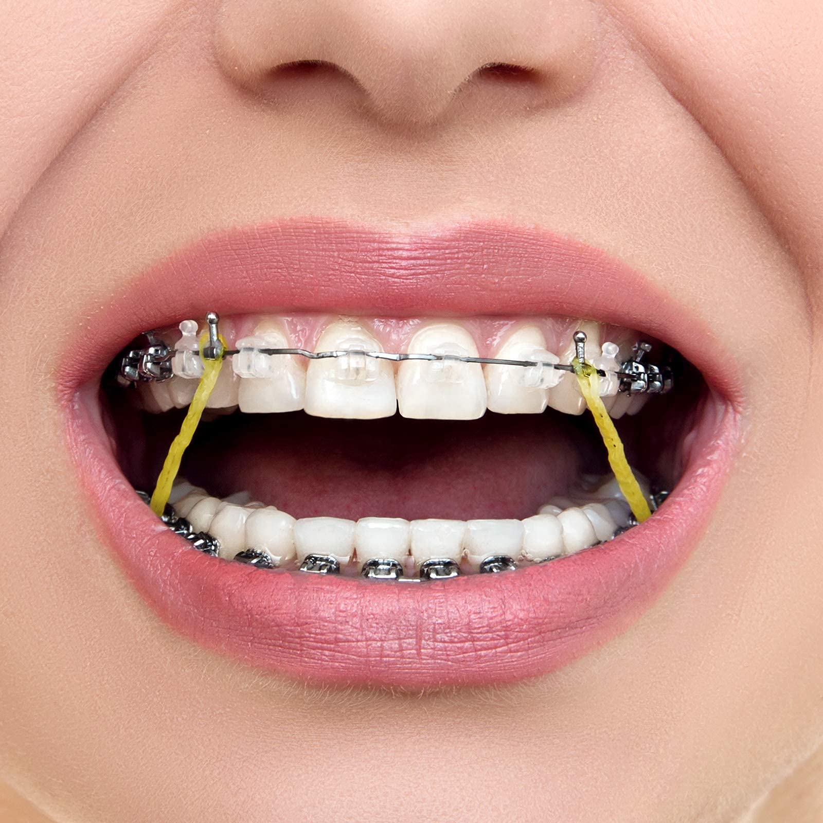 JMU Orthodontic Elastics 5/16 Medium, 500 Pack Latex Rubber Bands for Braces - Made in USA - Perfect for Teeth Alignment, Overbite Correction & Dental Appliances