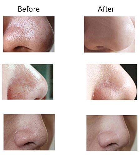 Vyoma Electric Blackhead & Pimple Remover - Acne Vacuum Suction Tool for Nose & Face | Microdermabrasion Pore Cleaner Device | Perfect for Daily Skincare & Spa Treatments