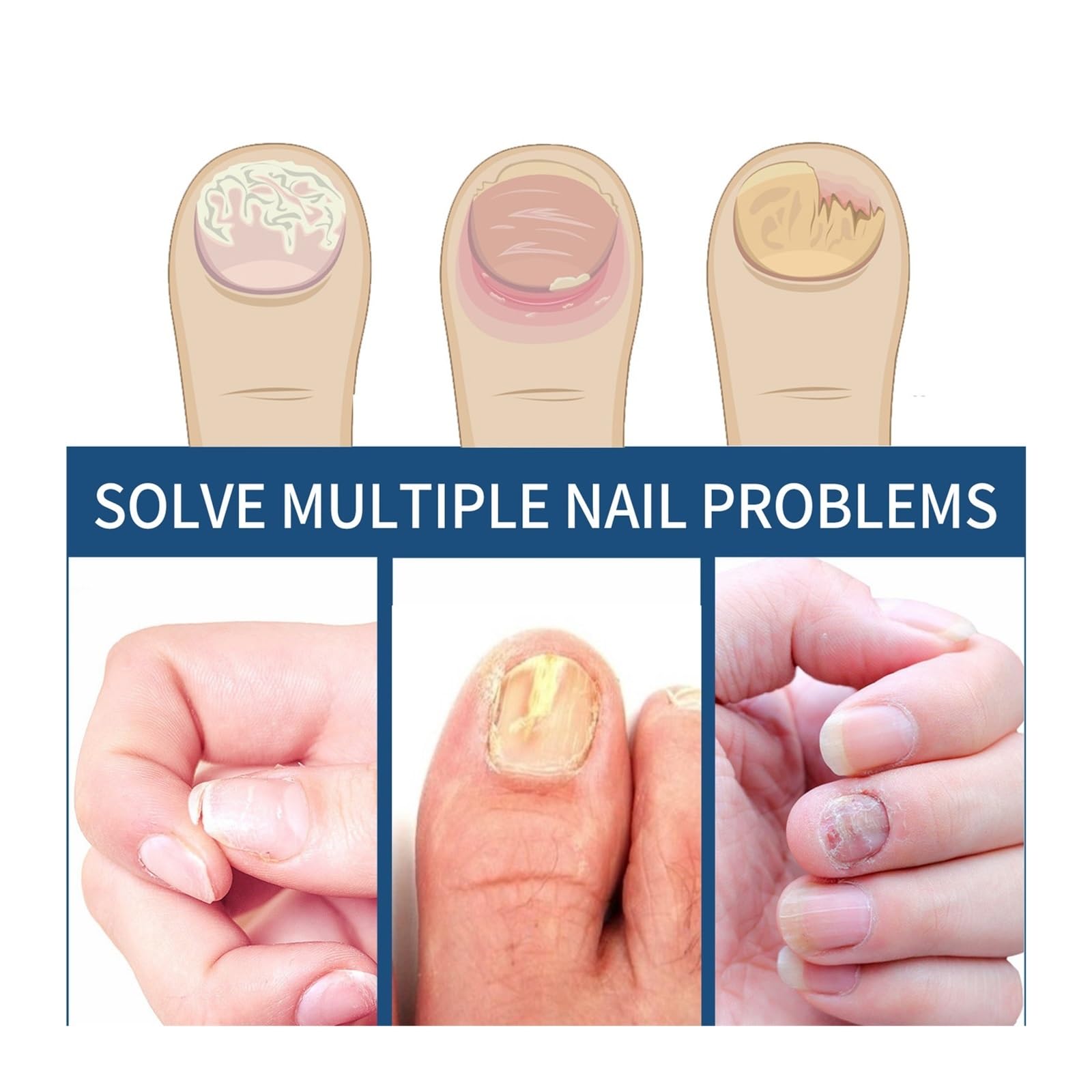 64 Pcs Nail Repair Patches - Damaged Nail Treatment for Cracked & Discolored Nails (Cream) | Strengthen & Beautify Nails for Salon-Quality Results at Home