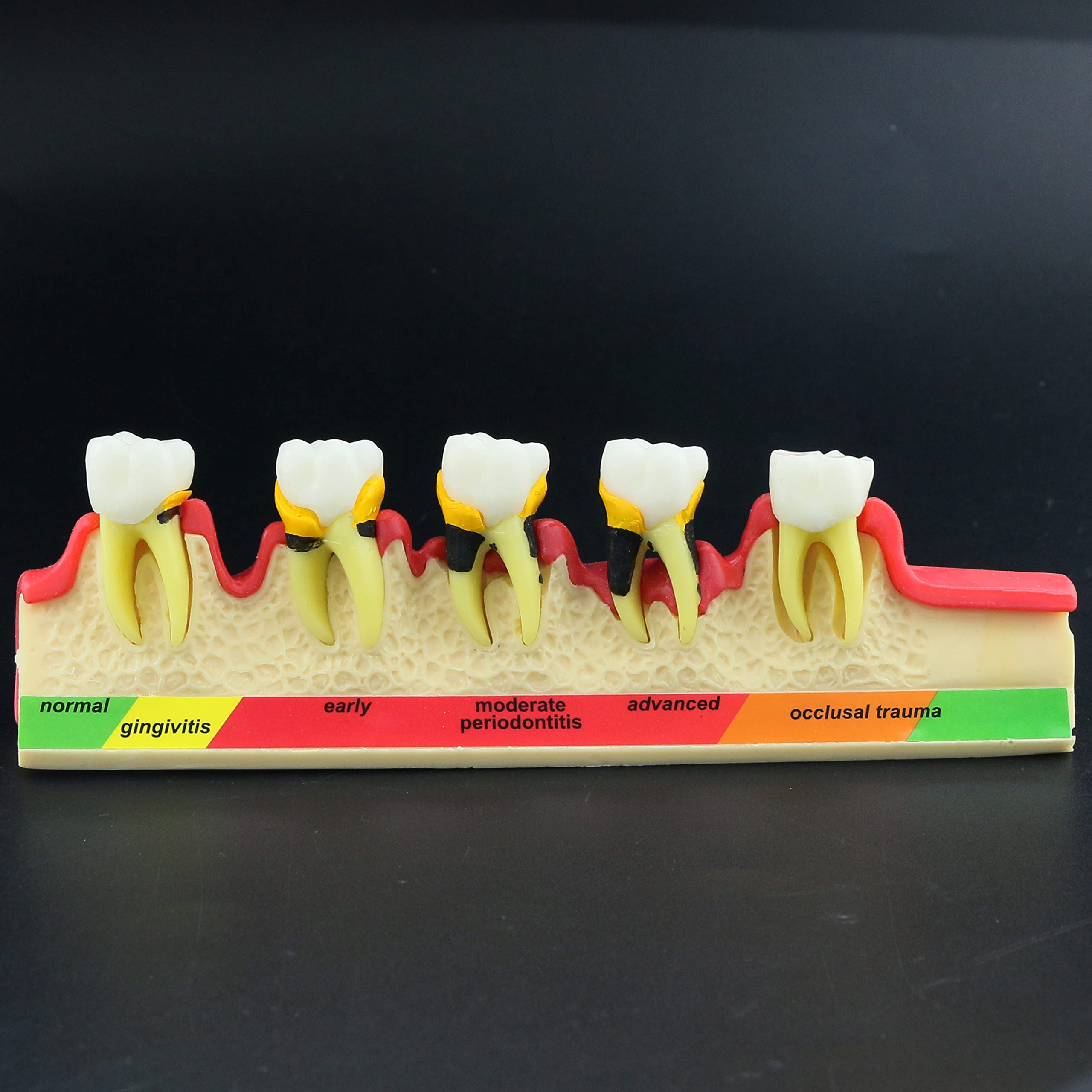 Dental Typodont Teeth Model for Adults & Children - Pathological Demonstration for Teaching & Studying (M4010) | Ideal for Dental Schools, Training & Clinical Practice