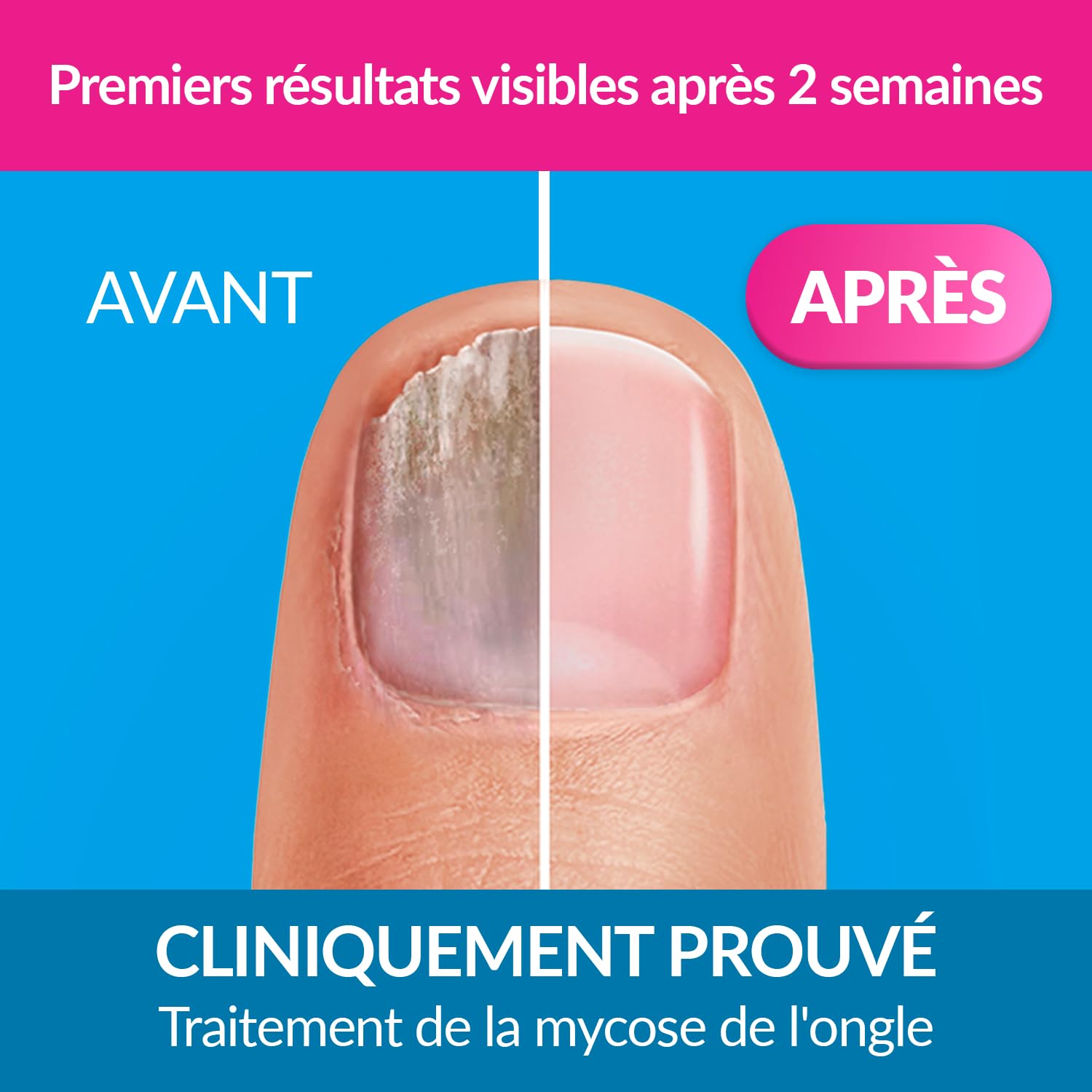 Excilor Fungal Nail Treatment - Effective Medical Solution for Toenail & Fingernail Fungus - Perfect for Athletes, Swimmers & Active Lifestyles