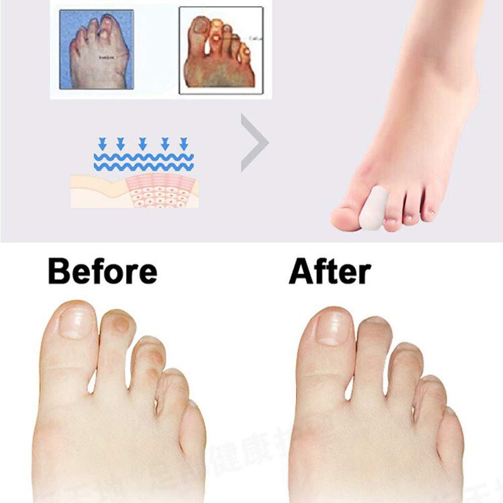 5 Pairs Breathable Silicone Gel Toe Caps for Ingrown Toenails - Big Toe Protector Pads & Sleeves for Pain Relief & Comfort (Ideal for Running, Hiking & Daily Wear)