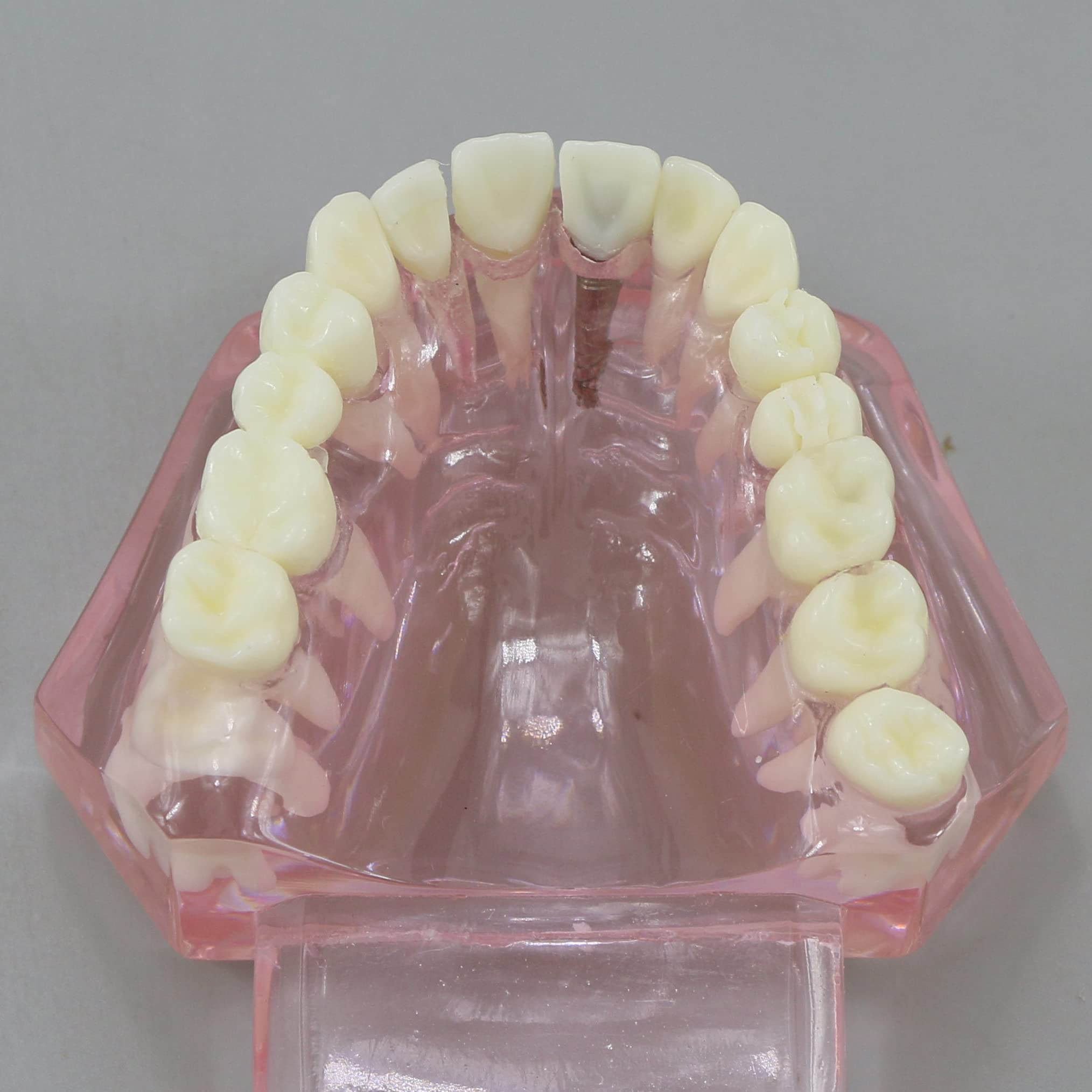 Dental Teeth Model - Implant Restoration Bridge Typodont for Dental Teaching & Study - Oral Pathology Demonstration (M2001 Pink) - Perfect for Dental Schools, Clinics & Training Labs