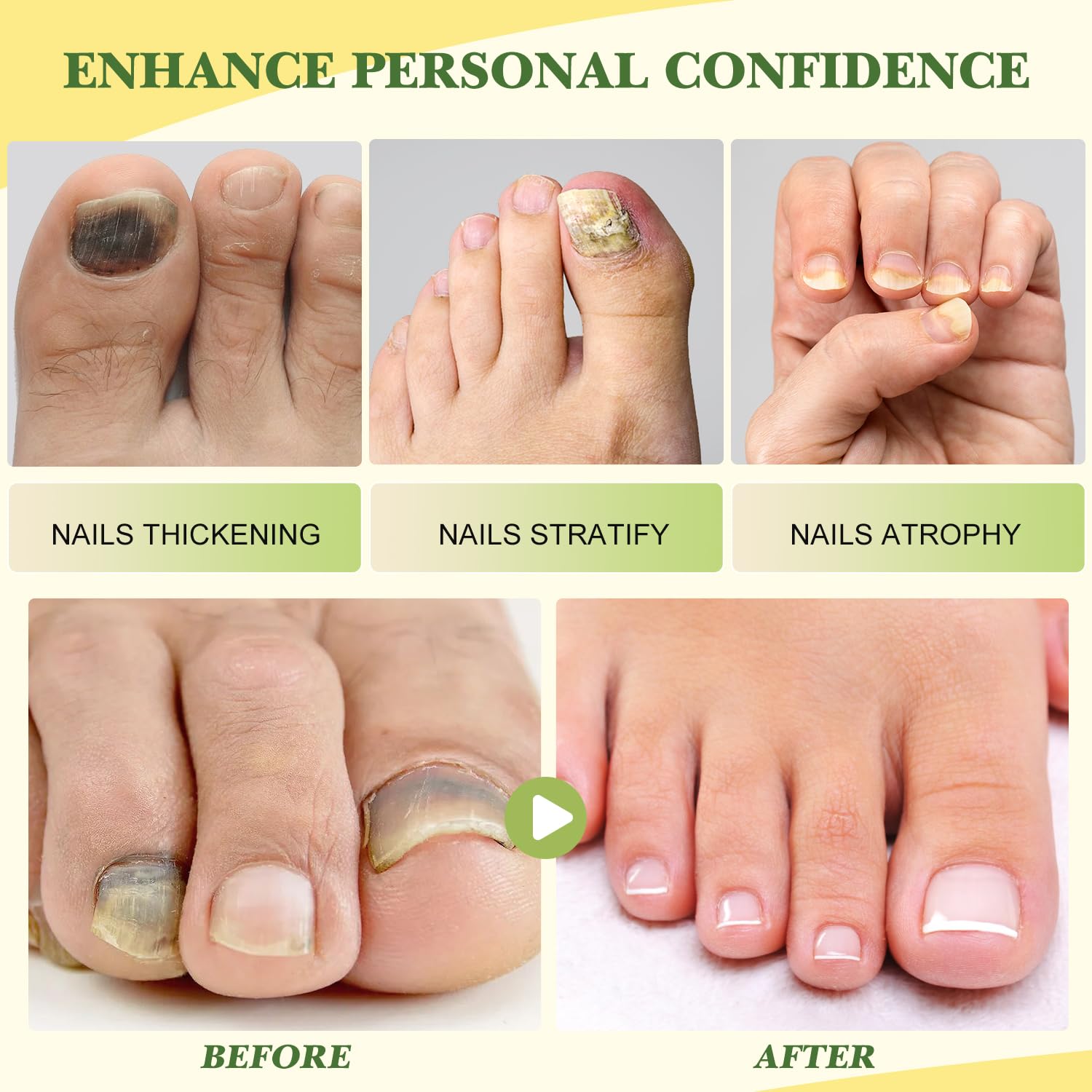 2Pcs Bee Venom Nail Treatment Serum for Growth & Repair - Strengthen & Protect Damaged Nails | Perfect for Brittle Nails & Fungal Treatment | At-Home Nail Care Solution