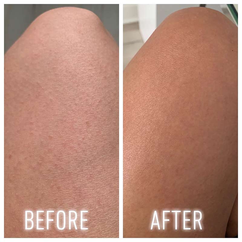 First Aid Beauty KP Bump Eraser Body Scrub with 10% AHA - Exfoliating Treatment for Keratosis Pilaris & Smooth Skin | Perfect for Dry, Bumpy Skin Care Routine