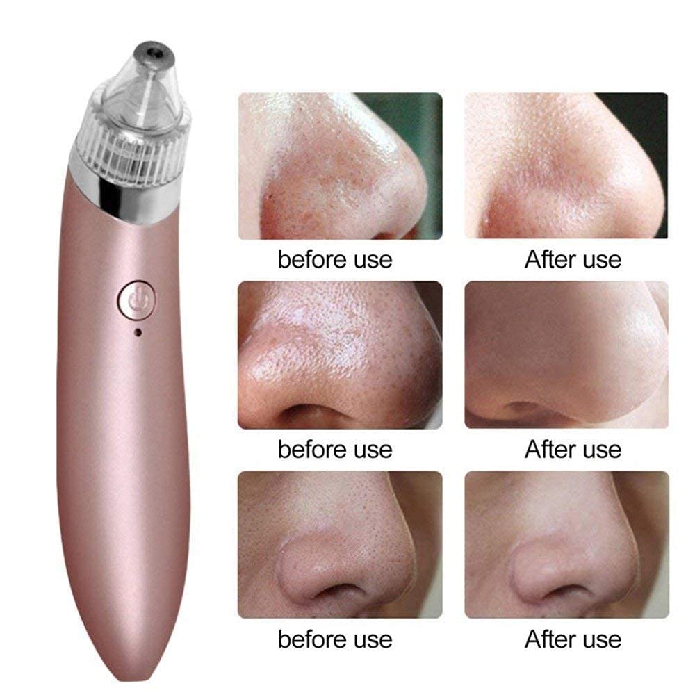 Tendula Professional Acne Pore Cleaner & Blackhead Remover Vacuum Kit - Facial Skin Care Tool for Pimple & Blemish Removal | Perfect for Daily Skincare Routine & Spa Treatments