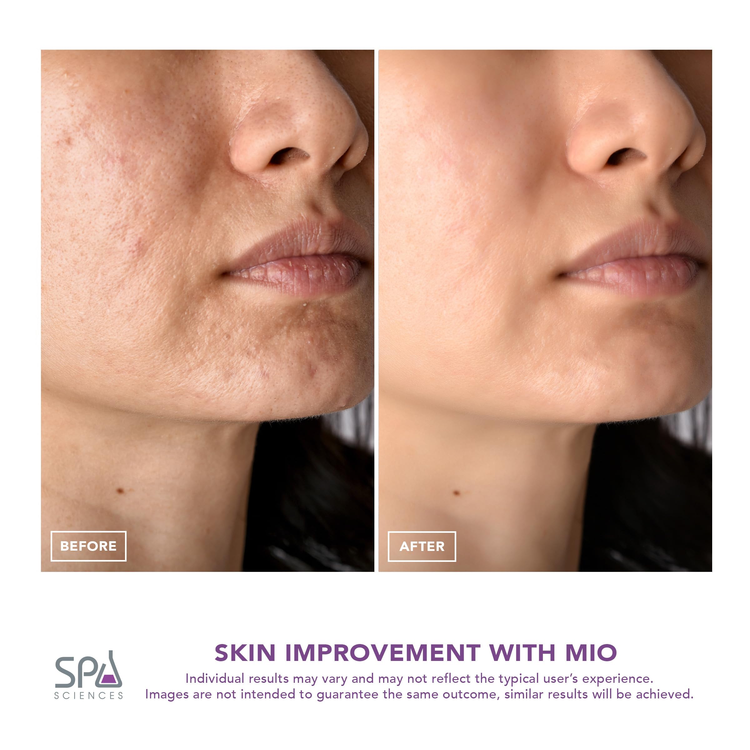 Spa Sciences MIO Diamond Tip Microdermabrasion Device - Professional Blackhead Remover & Pore Cleanser for Acne Scar Reduction, Wrinkle Treatment & Skin Exfoliation | At-Home Facial Care for Clearer, Smoother Skin | Perfect for Daily Skincare Routine & Spa Treatments