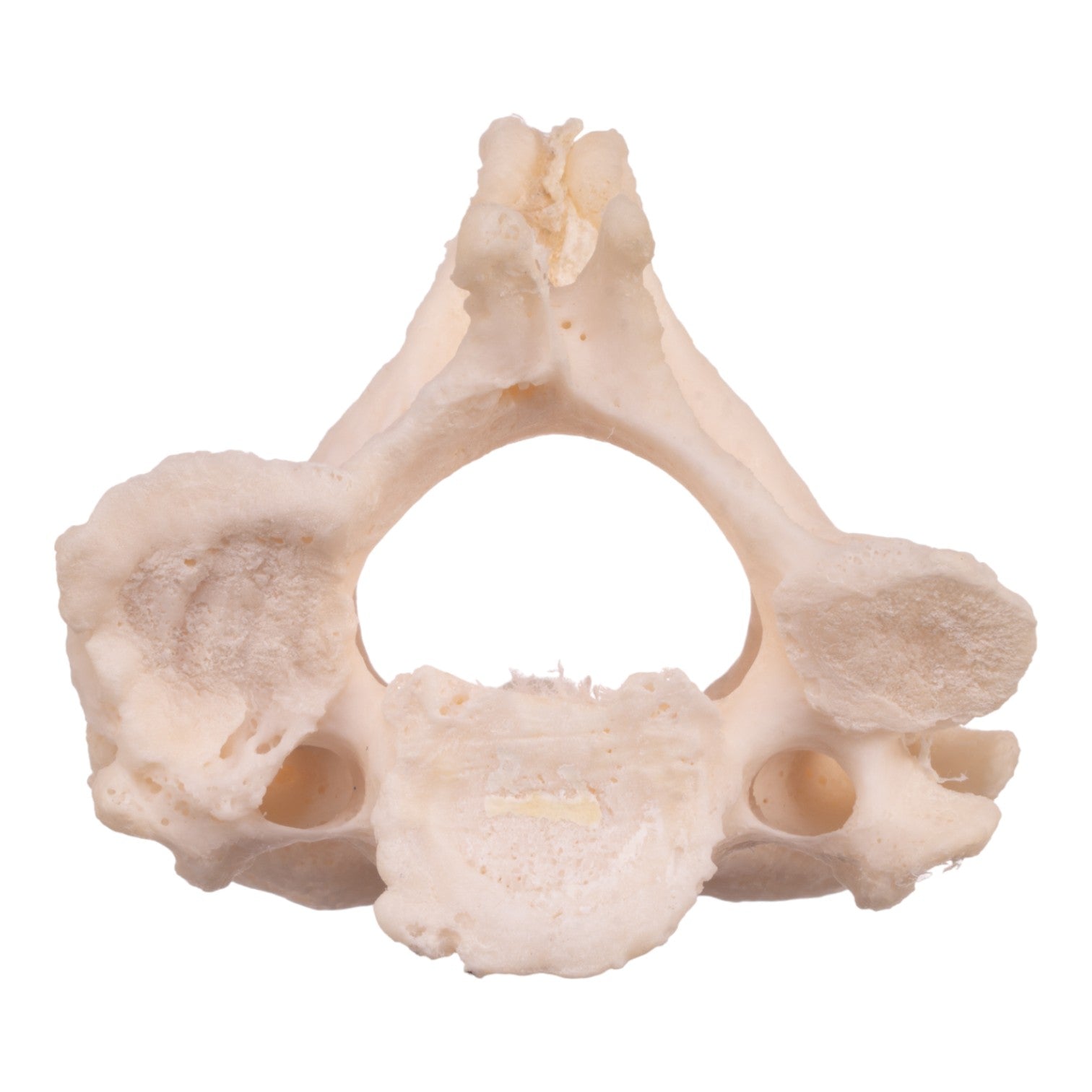 High-Quality Real Research Human Cervical & Axis Vertebrae Fused Specimen - Perfect for Medical Studies, Anatomy Education, and Surgical Training