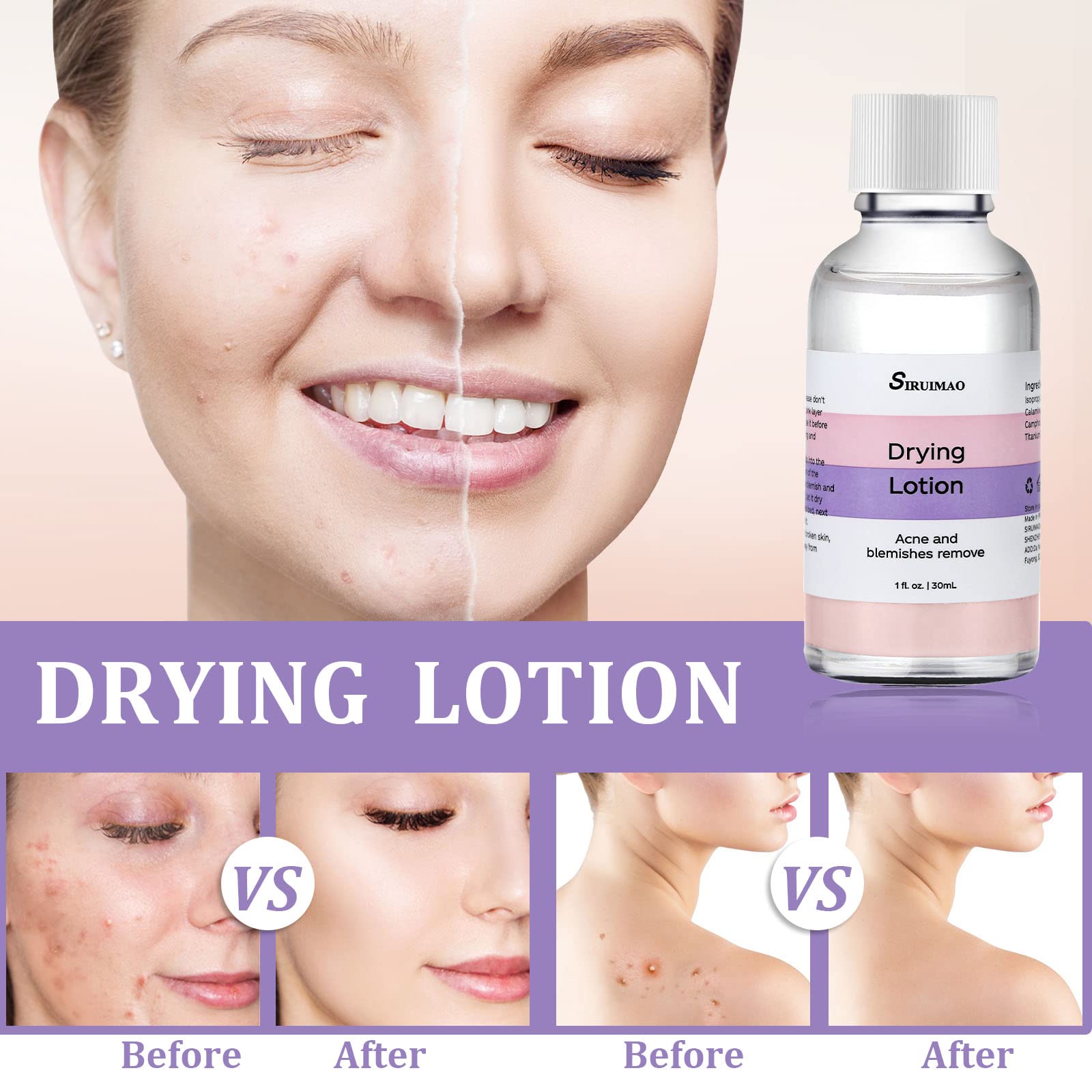 Stubborn Acne Drying Lotion (1OZ) - Overnight Acne Spot Treatment with Salicylic Acid for Face & Body | Fast-Acting Pimple Lotion to Dry Out Blemishes, Zits & Unclog Pores | Perfect for Teen & Adult Acne Care, Travel-Friendly Skincare Solution