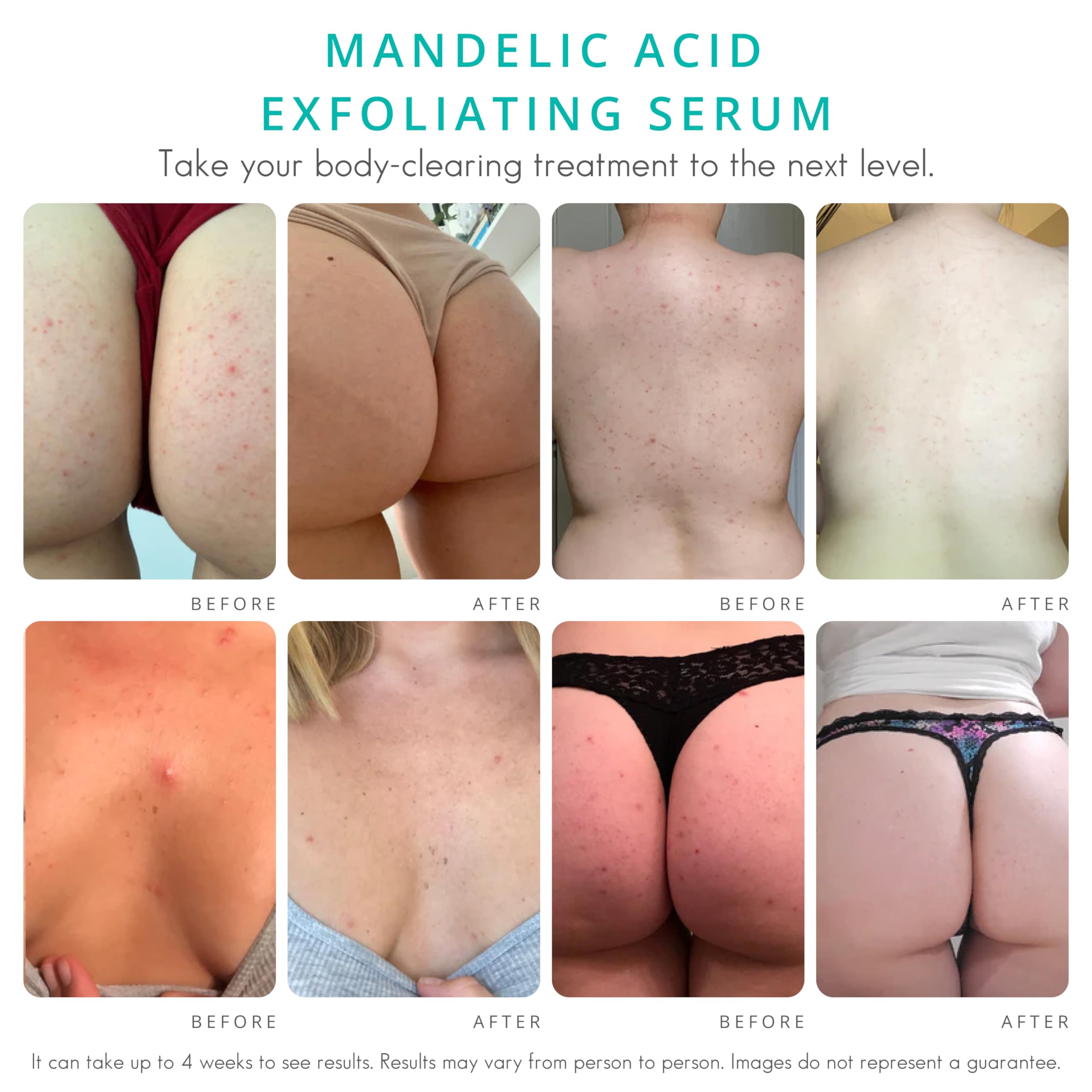 Advanced Body Clearing Serum Level 2 - Severe Acne & Folliculitis Treatment for Back, Butt, Chest, Thighs & Shoulders - Mandelic Acid Formula with Natural Antibacterial & Antifungal Properties - 1 fl oz (4 oz) - Perfect for Post-Workout Breakouts & Summer Skin Care