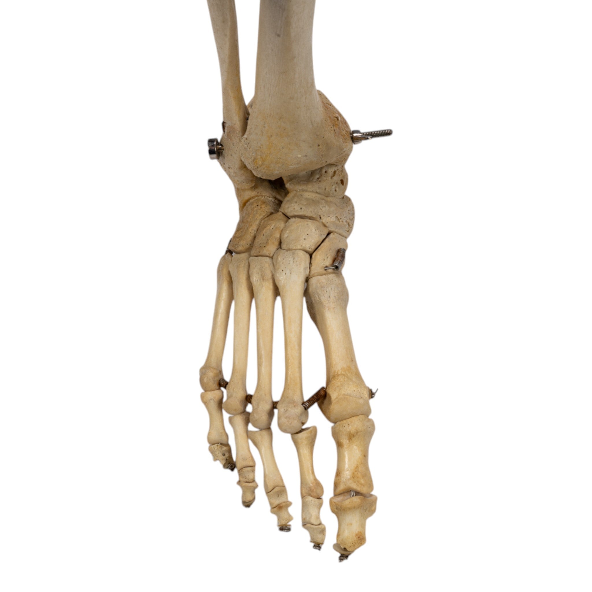 Realistic Human Right Leg Prosthetic - Partial & Articulated for Medical Training, Amputee Rehabilitation & Anatomy Study