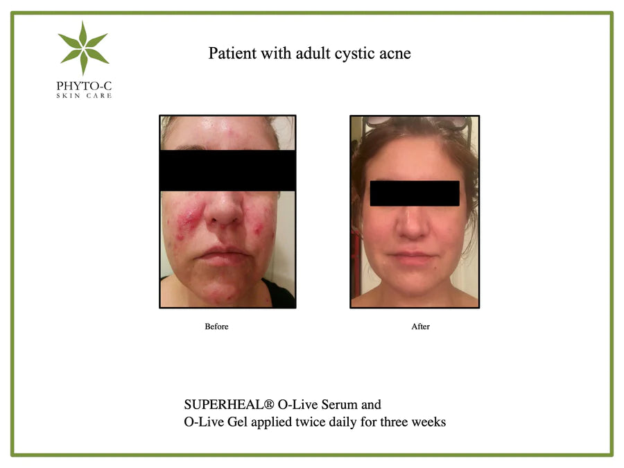 Phyto C Superheal O Live Serum - Antioxidant Skin Repair Serum for Face - Brightening & Anti-Aging Treatment - Perfect for Daily Skincare Routine & Night Care