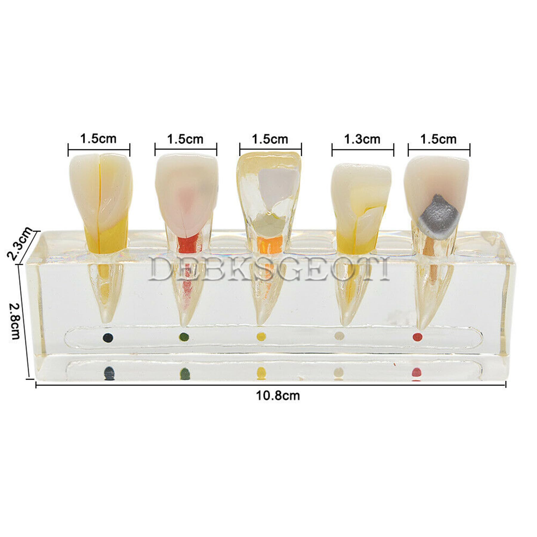 Dental Typodont Model for Caries Treatment - M4008 Anatomical Demonstration Kit for Incisor & Diseased Teeth | Dental Education, Student Practice & Clinical Training