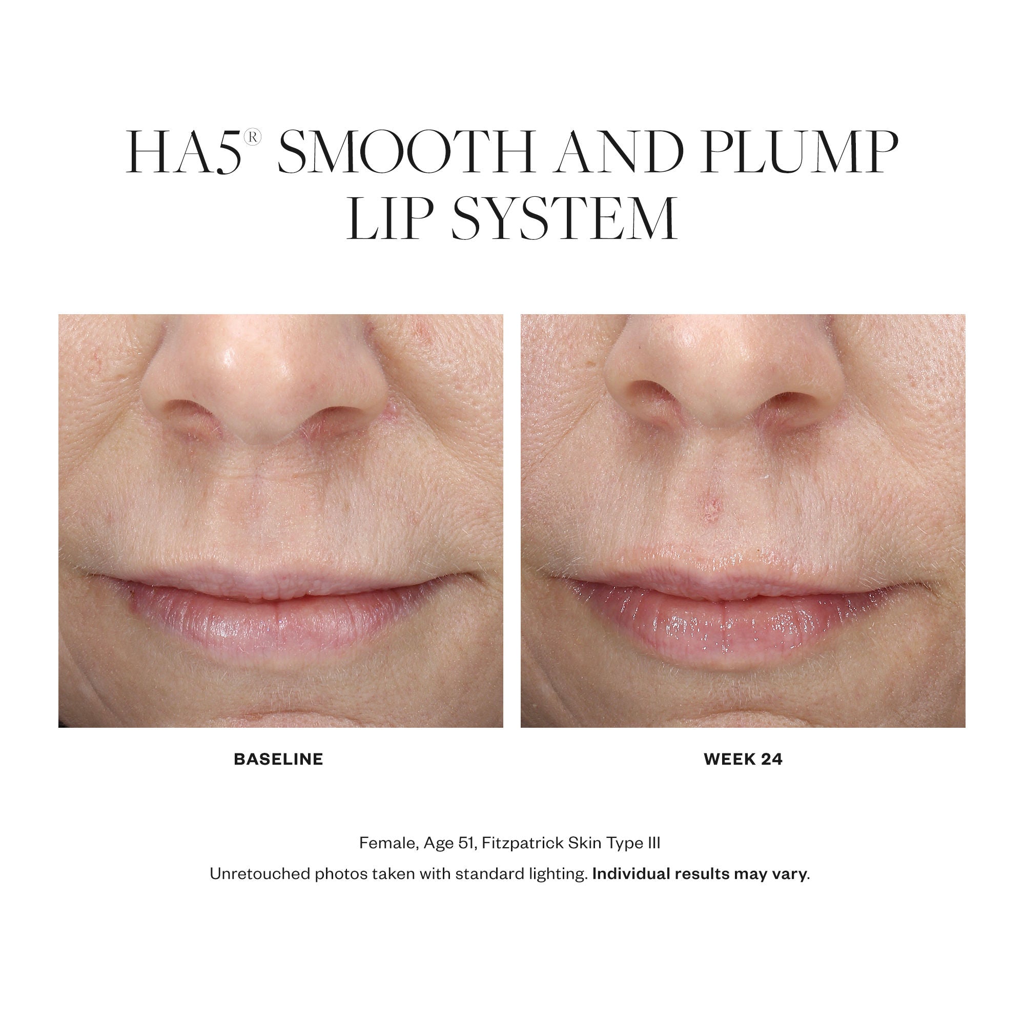 HA5 Smooth and Plump Lip System - Hydrating Lip Care for Fuller Lips | Perfect for Daily Moisturizing & Nighttime Lip Treatment
