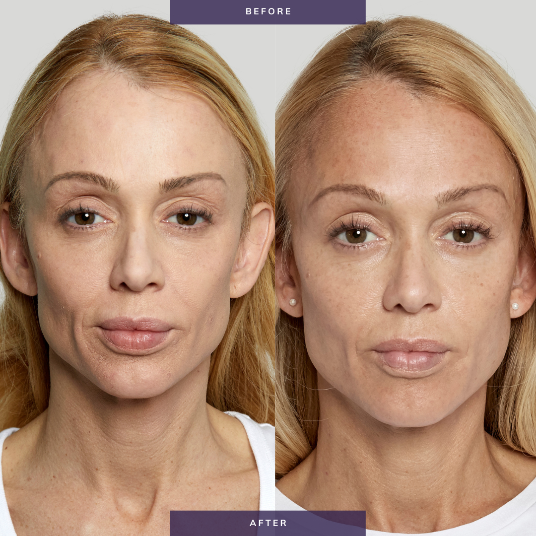 Sculptra Injectable Dermal Filler for Facial Rejuvenation & Wrinkle Reduction - Professional Anti-Aging Treatment for Cheeks, Temples & Nasolabial Folds | Dermatologist-Approved Collagen Stimulator for Natural-Looking Results | Perfect for Special Occasions & Confidence Boosting